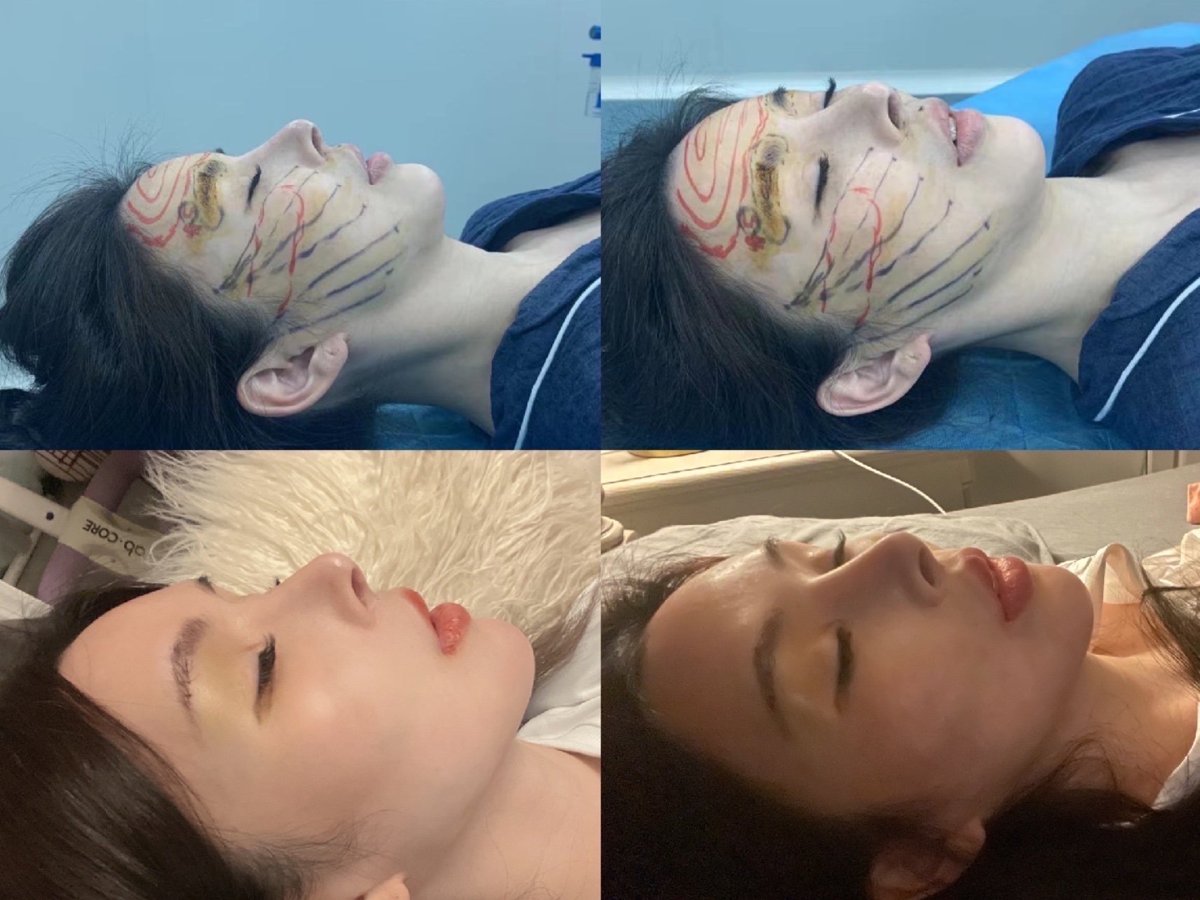 手术:假体眉弓额头吸脂线雕埋线提升