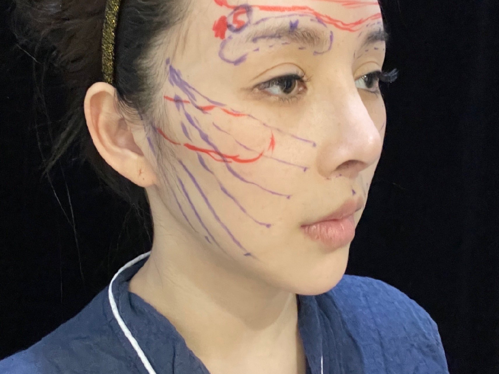 手术假体眉弓77额头吸脂77线雕埋线提升