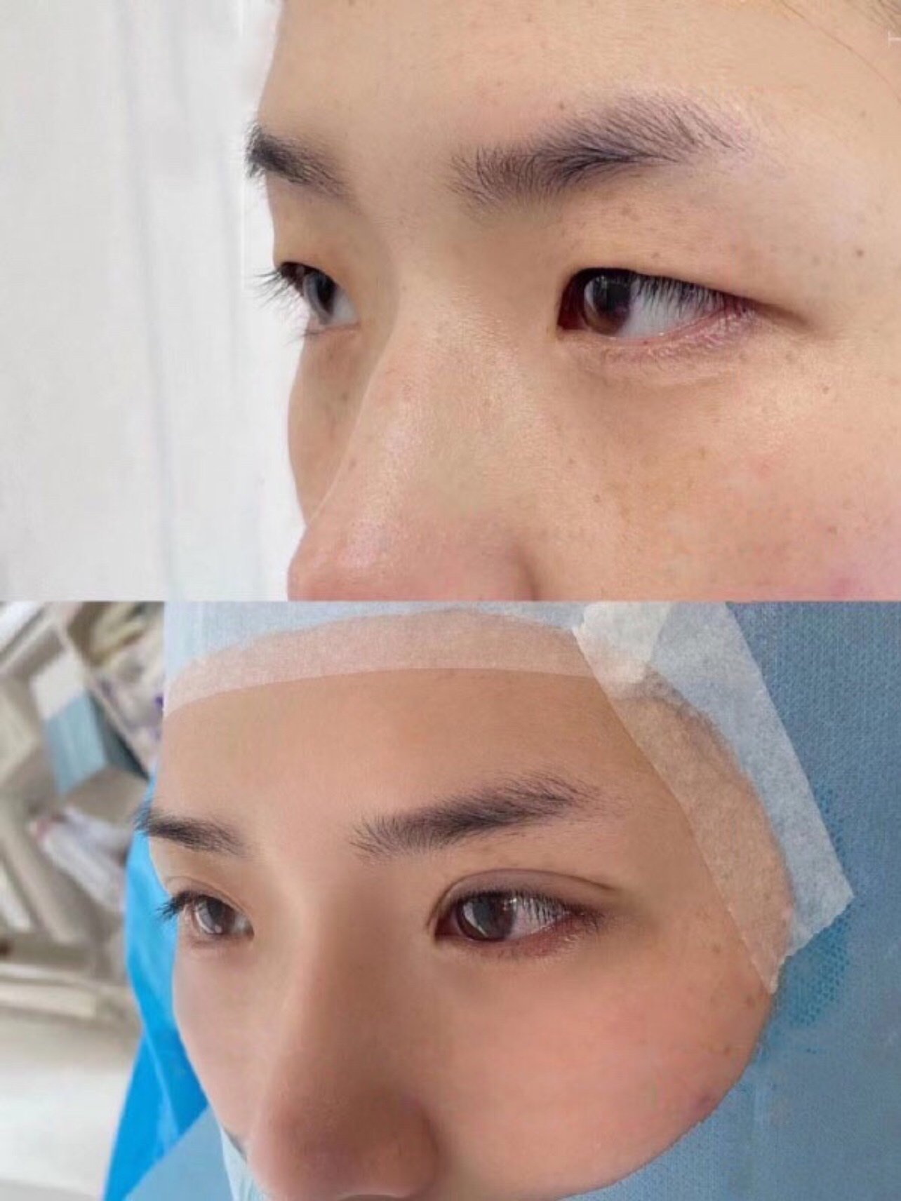 手术项目:日式无痕双眼皮 双眼皮形状:自然开扇形 专属眼部设计