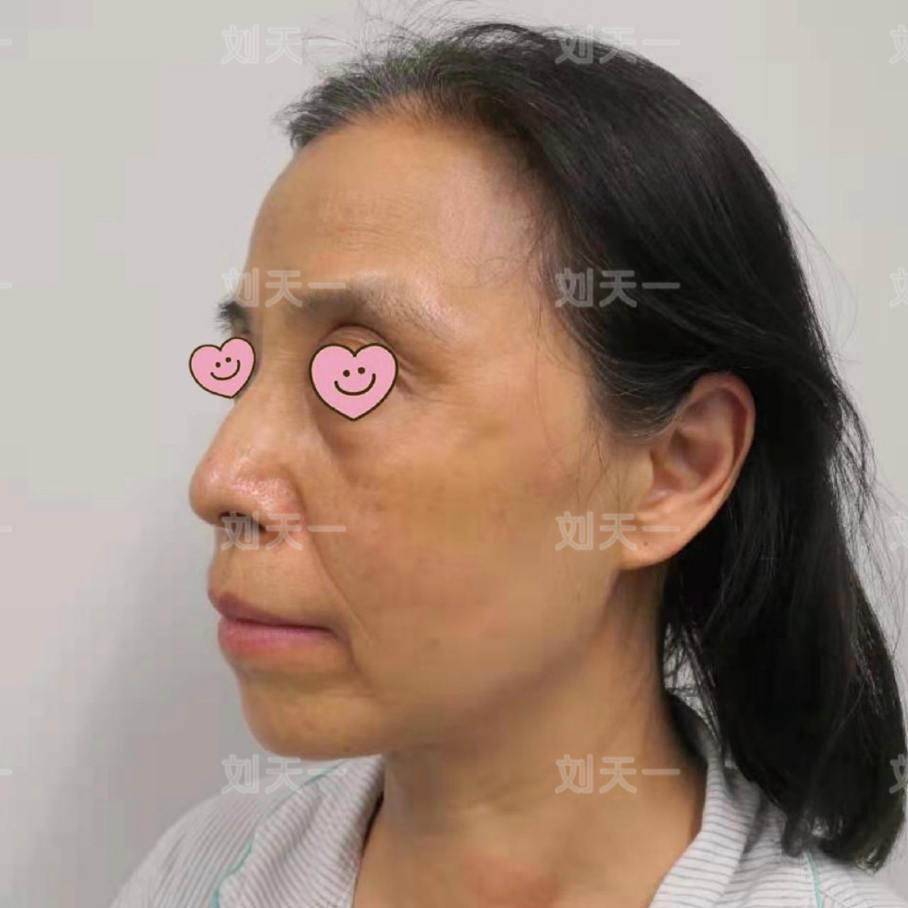 眼眶处凹陷导致眼角下垂鱼尾纹纵生,苹果肌干瘪下垂,_圈子-新氧美容