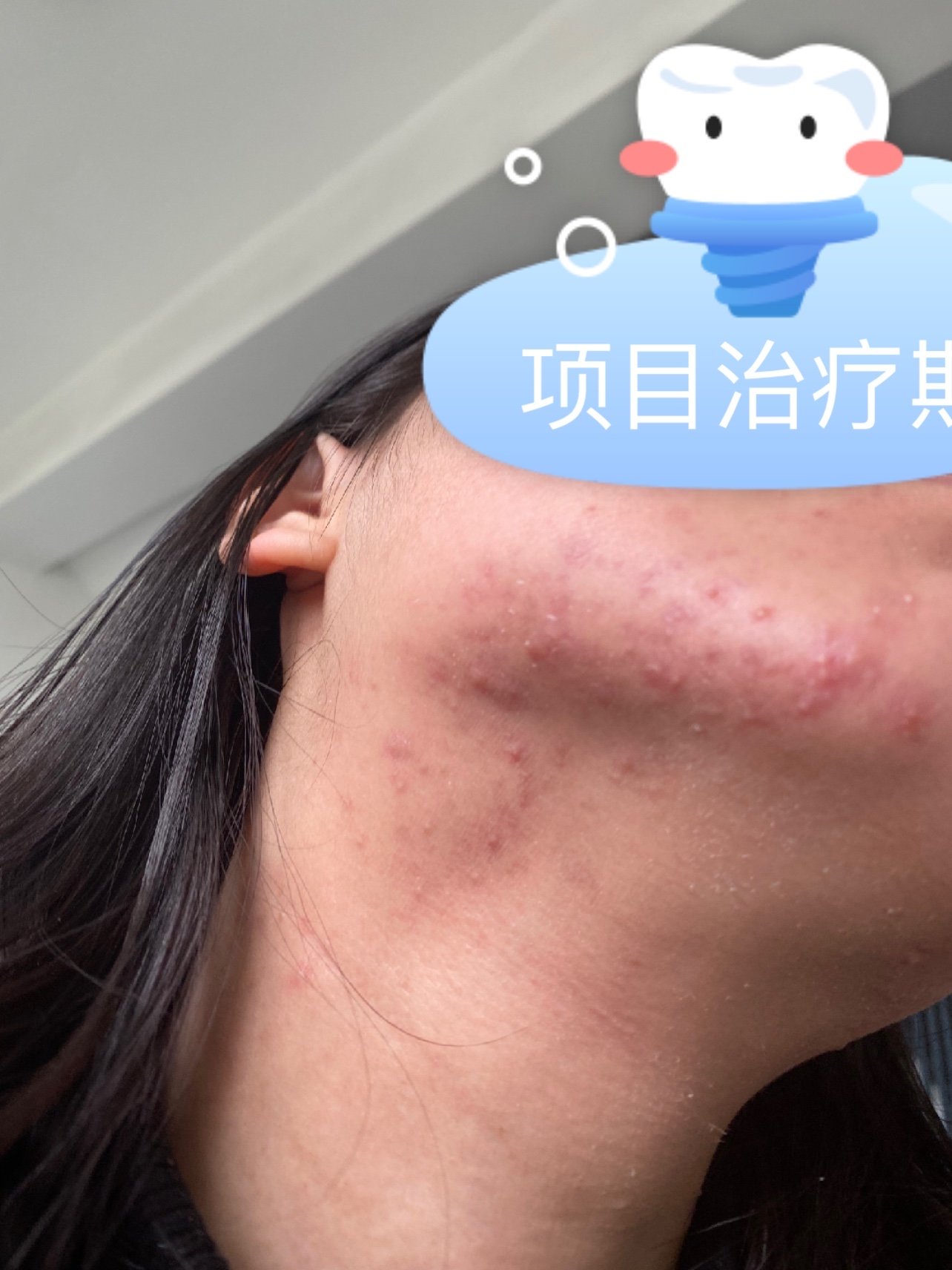 红蓝光_圈子-新氧美容整形