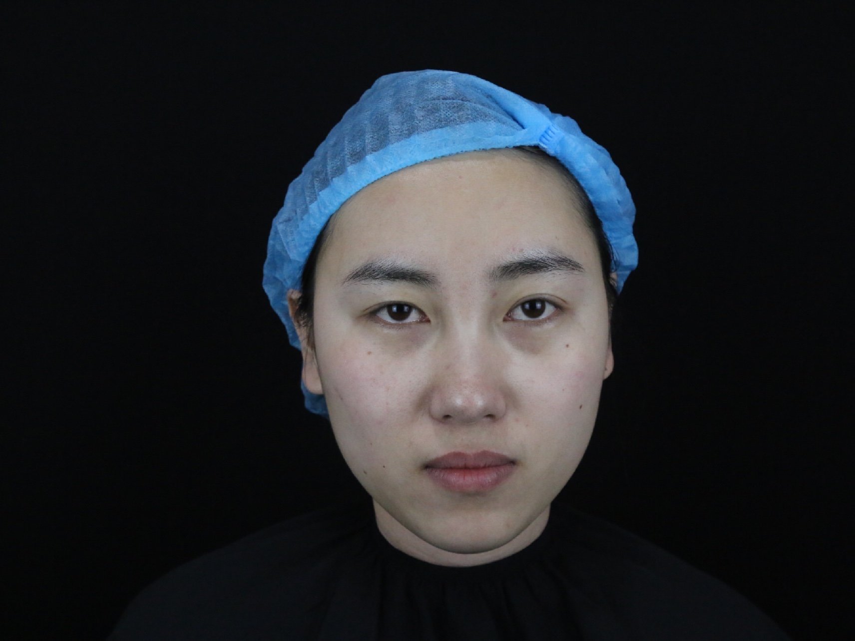 [:163]体验前变美诉求:黑眼圈重,眼圈发青,眼_圈子-新氧美容整形