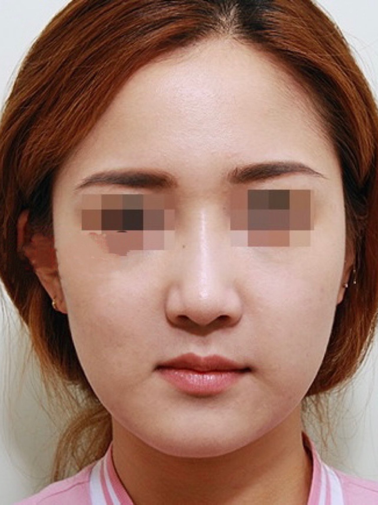 求美者原生鼻存在低鼻,鼻翼肥大,鼻基底凹陷的问题,_圈子-新氧美容