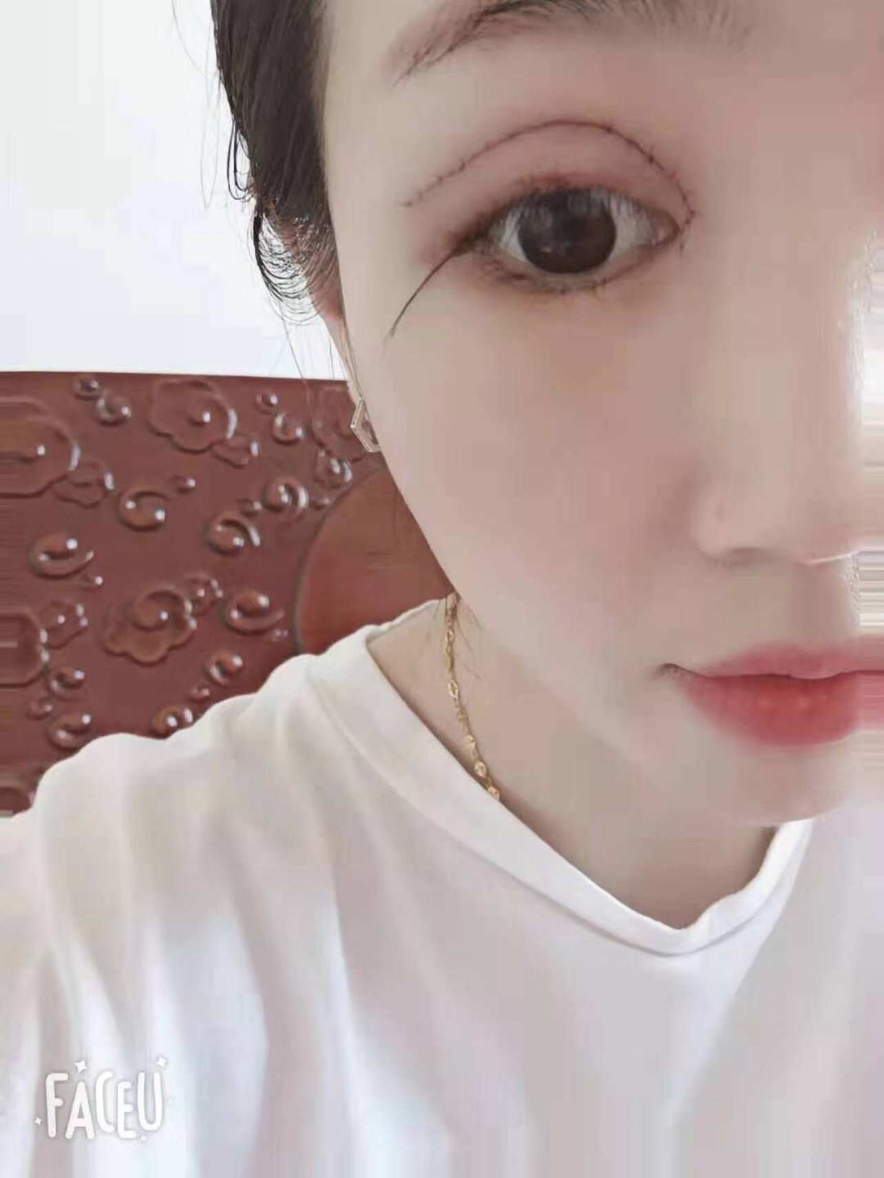 全切双眼皮术后三天天,什么看着肿胀越来越厉害了,有_圈子-新氧美容