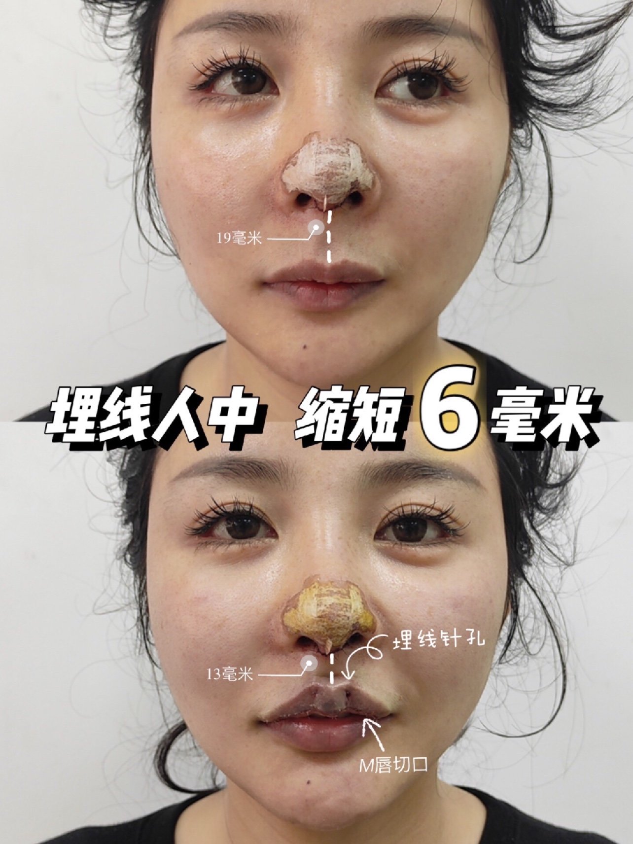 速愈美线雕埋线人中缩短术后当天