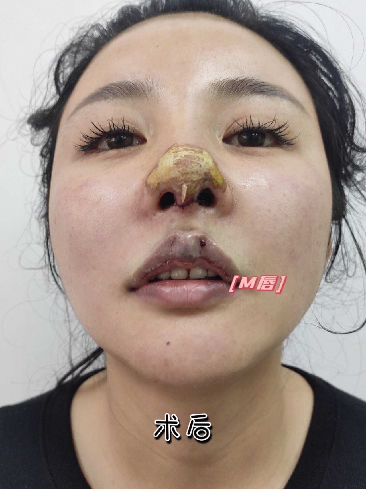 速愈美线雕(埋线)人中缩短术后当天～医院:@成都_圈子-新氧美容整形