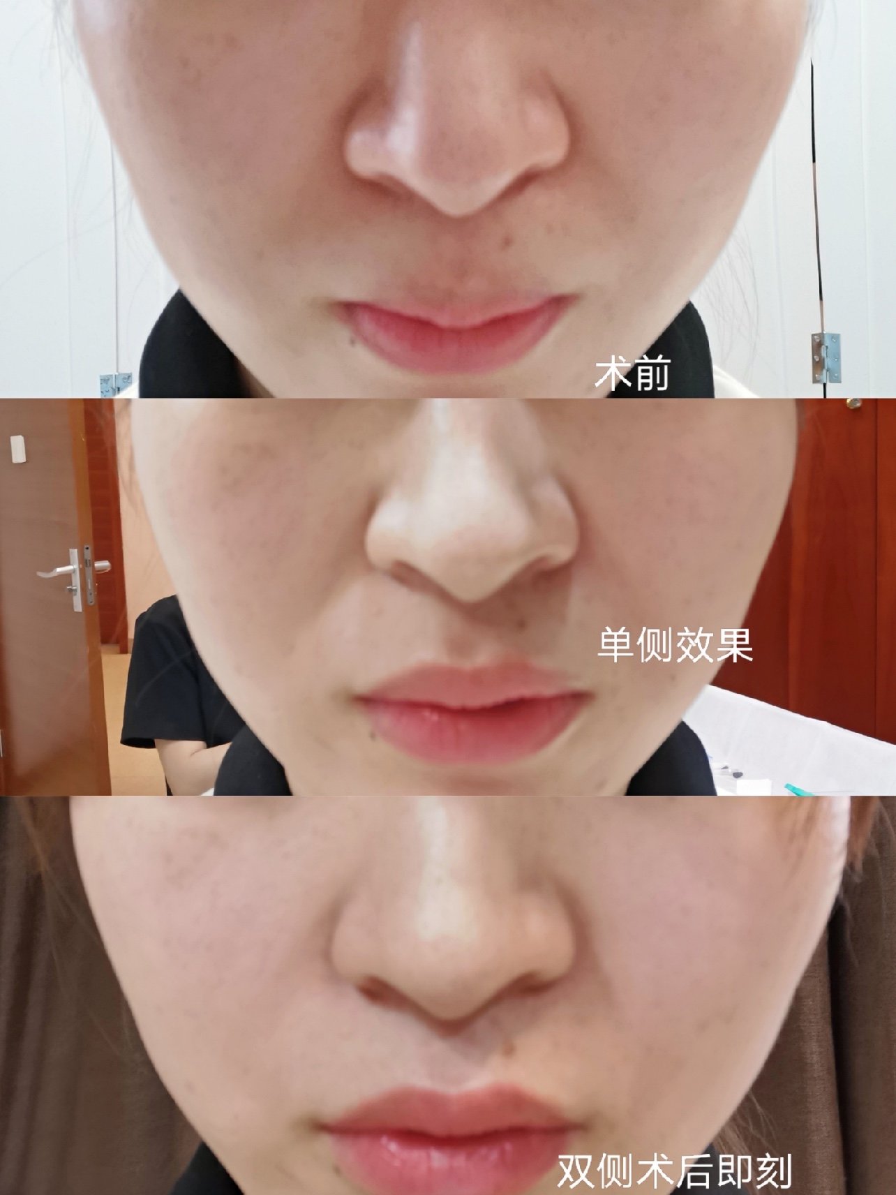 vsta美容填充干细胞还是玻尿酸好的简单介绍 - 中国人事考试网