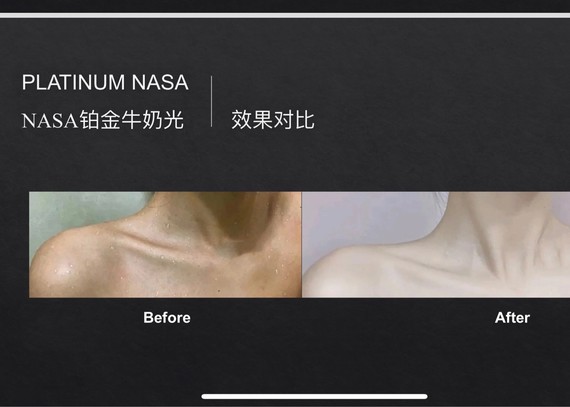 今天我们来扒一扒赫赫有名的飞顿激光almalase_圈子-新氧美容整形