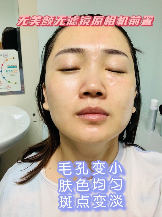 今天我们来扒一扒赫赫有名的飞顿激光almalase_圈子-新氧美容整形