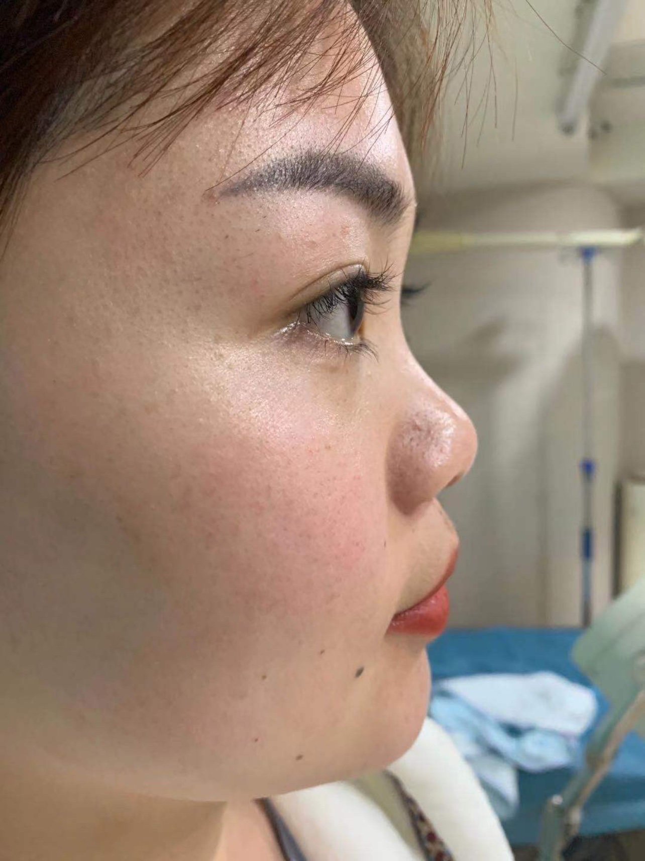 求美者原生鼻型存在鼻背低,鼻头圆钝,后缩,鼻翼肥大_圈子-新氧美容