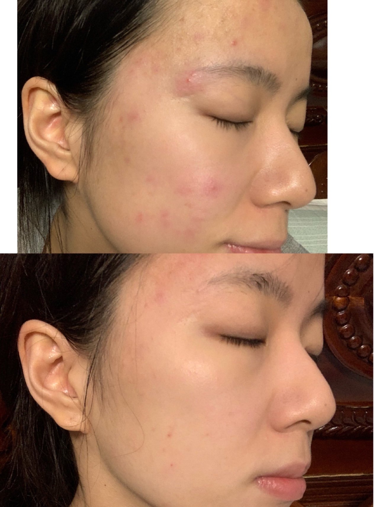 使用妍依净的祛痘美肌套组已经有一段时间啦来反馈一下我的体验感受