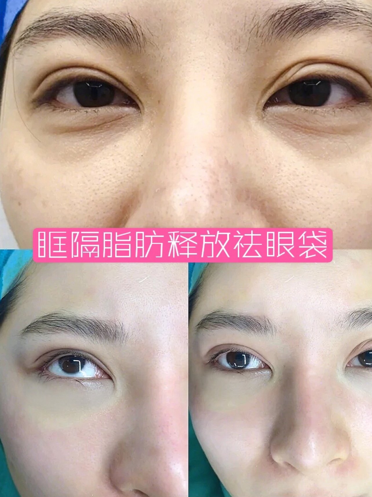 眼袋黑眼圈以及比较明显的泪沟