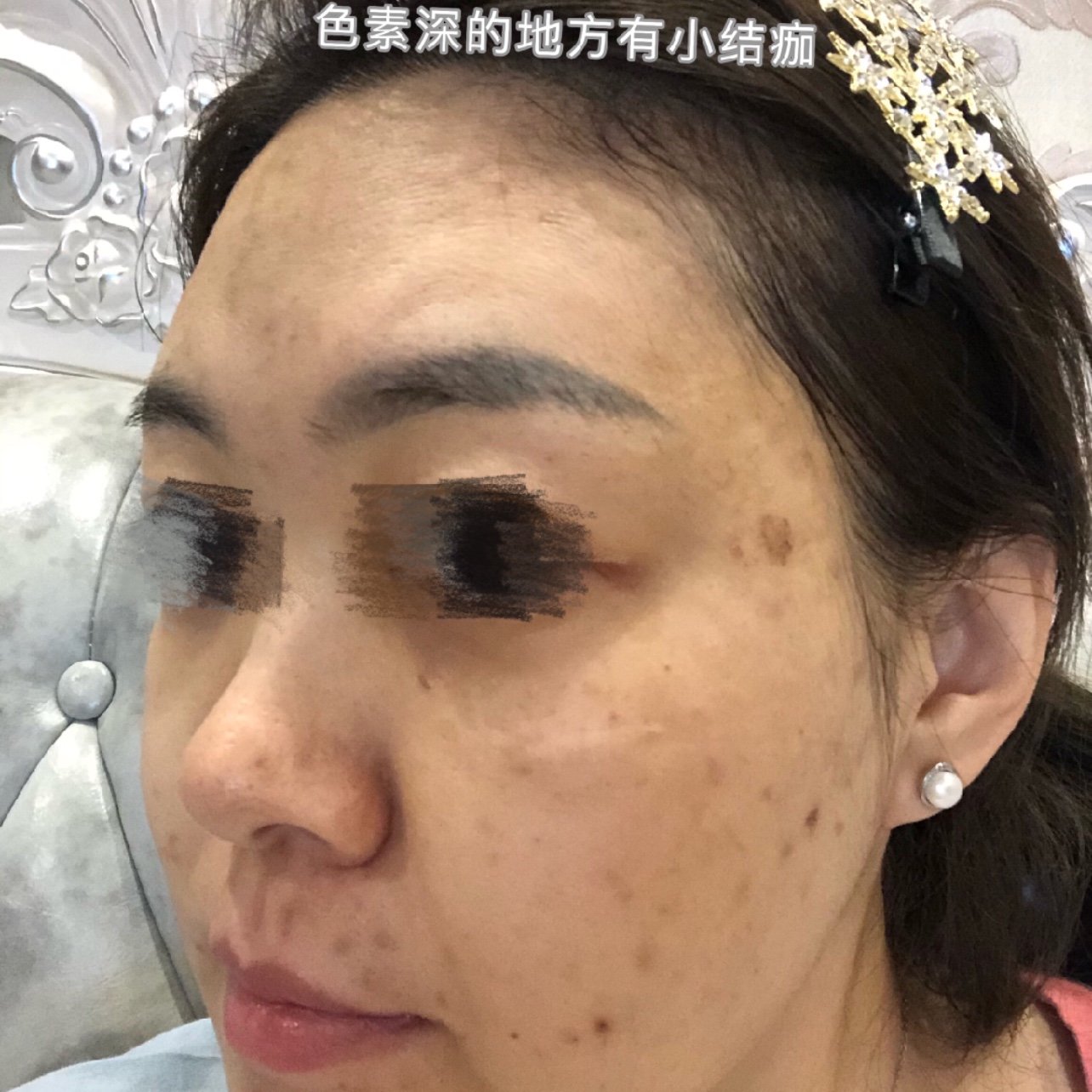 我来啦~这是做完m22光子嫩肤两周后的效果反馈