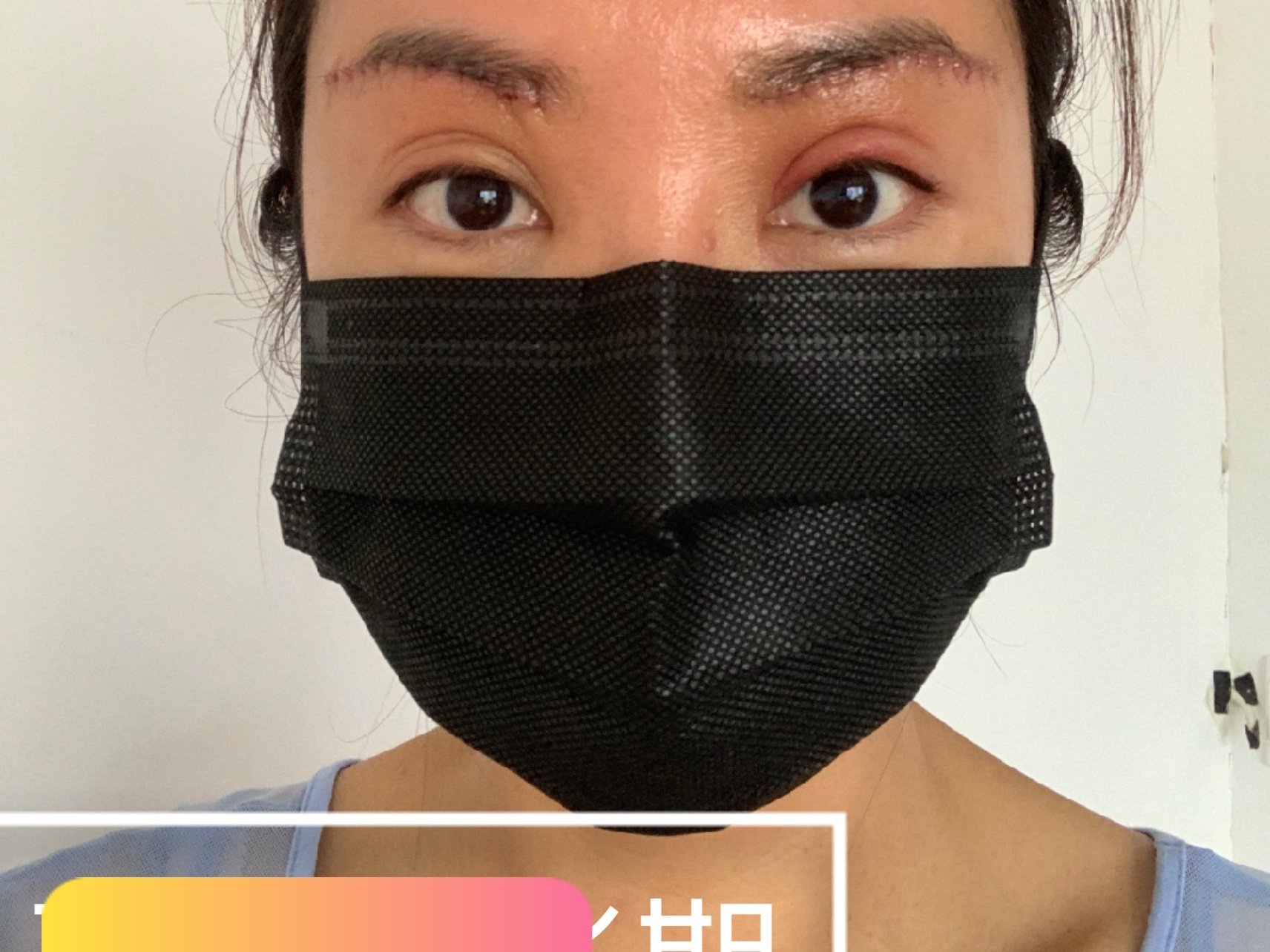 眉毛提升手术_眉毛术后修复_提眉术多久可以恢复自然