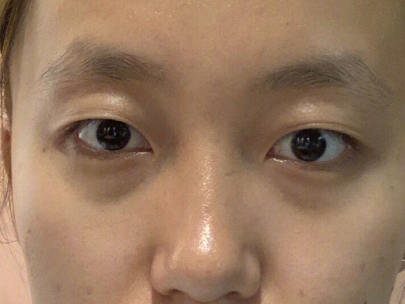 我属于眼下皮肤特别薄,小时候连血管都能看的清清楚楚的那种.