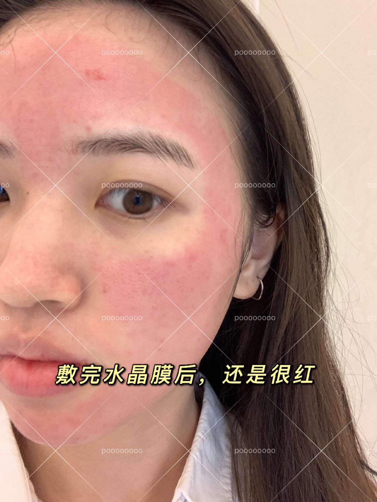 伊肤泉控油微针祛痘套组术后即刻