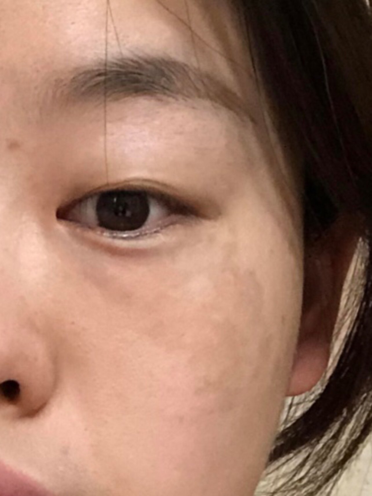 图一是刚开始的时候,脸上做完光子嫩肤后,虽然还是能_圈子-新氧美容