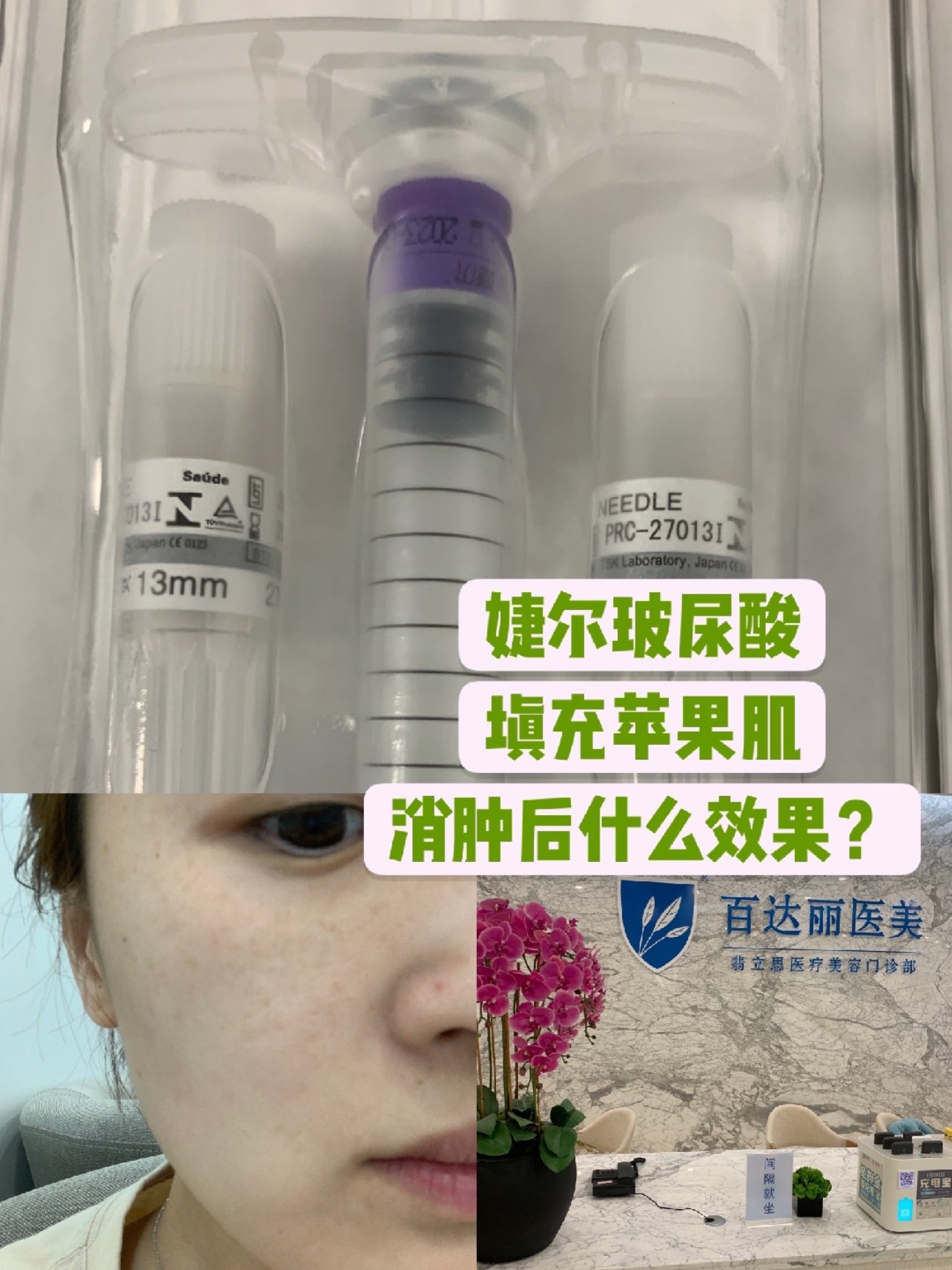 新氧试用官婕尔玻尿酸