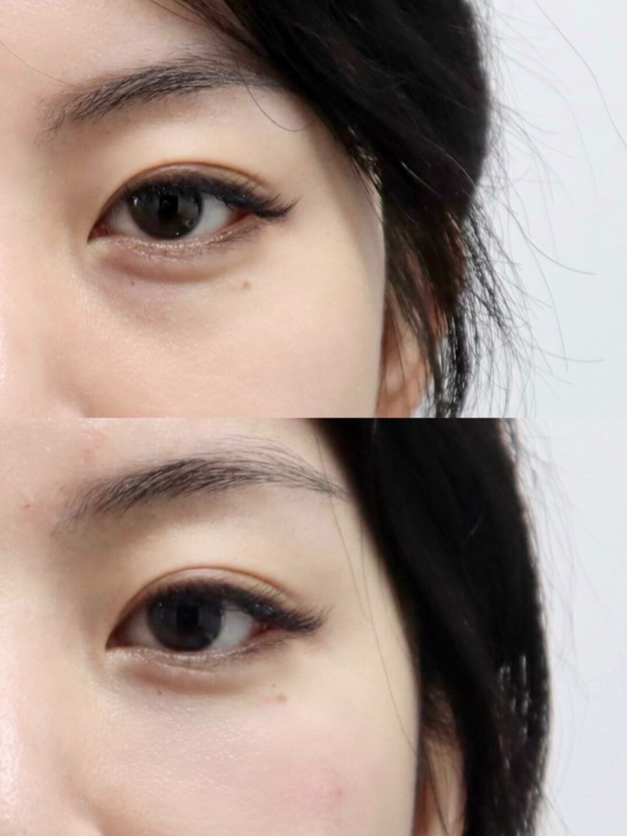 传统泪沟填充都是用玻尿酸,容易有眼下凸起和丁达尔现象.