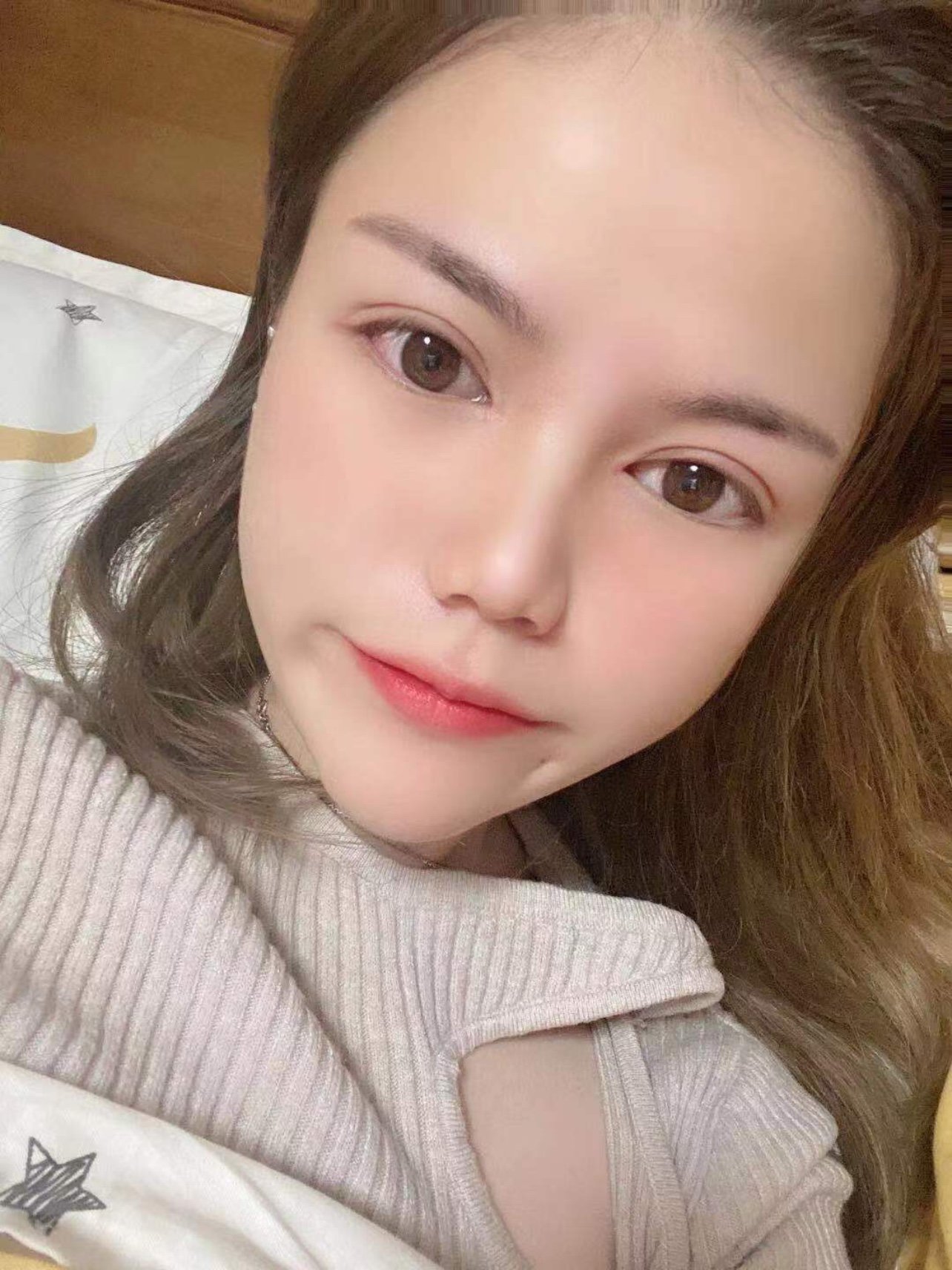 眼部多项双眼皮术后10天