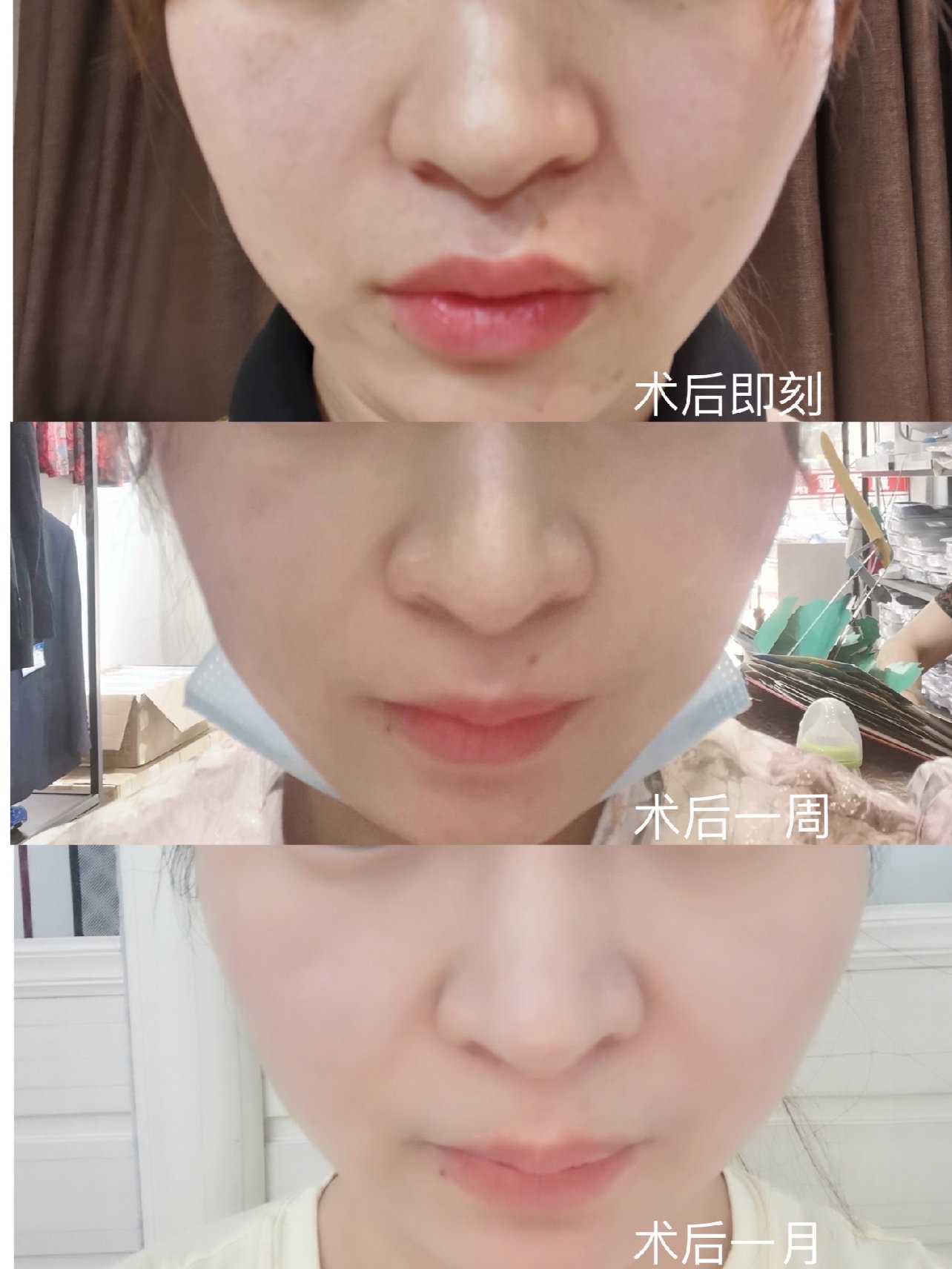 婕尔玻尿酸鼻基底填充一月反馈