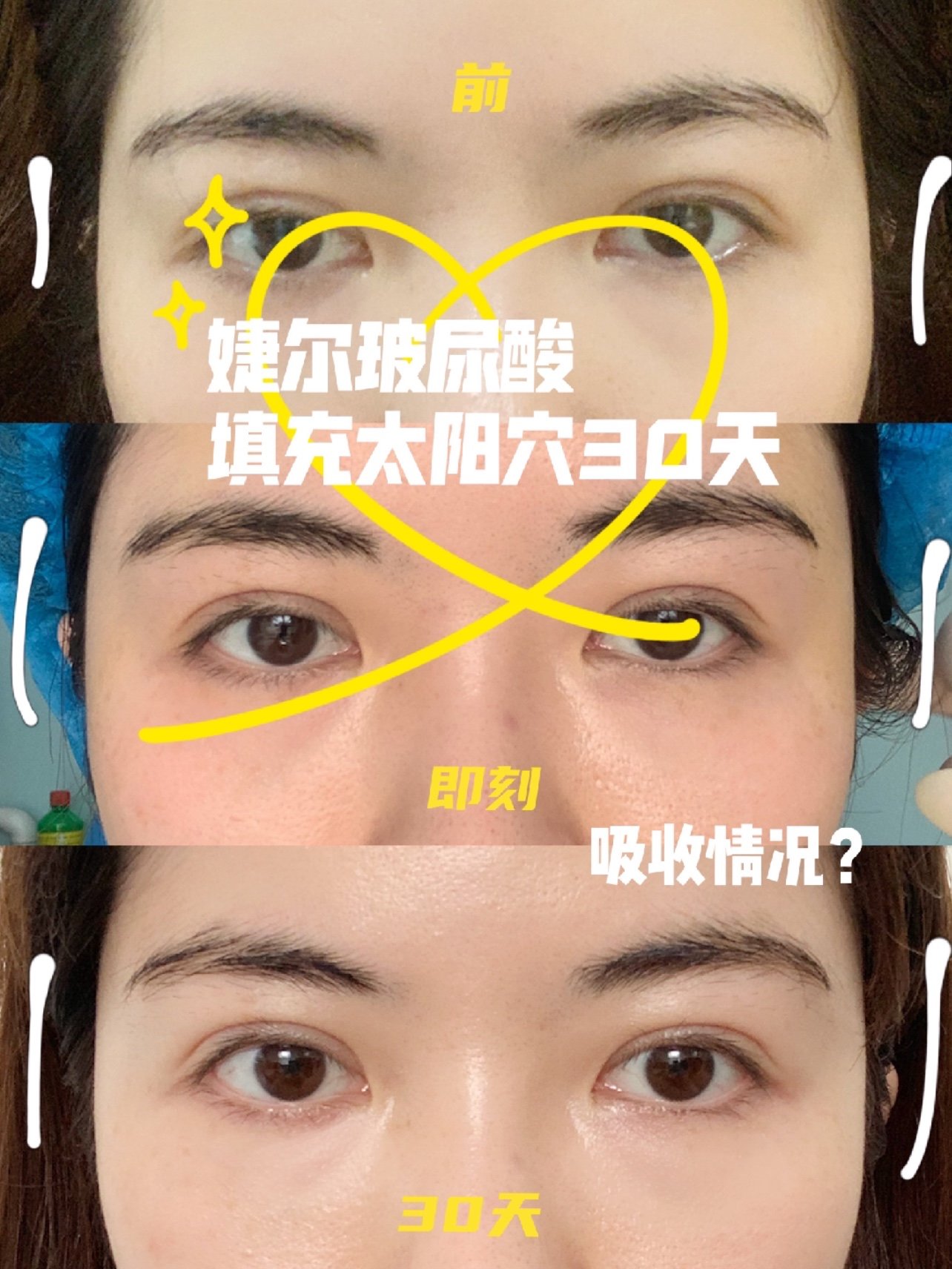 婕尔玻尿酸填充太阳穴30天效果