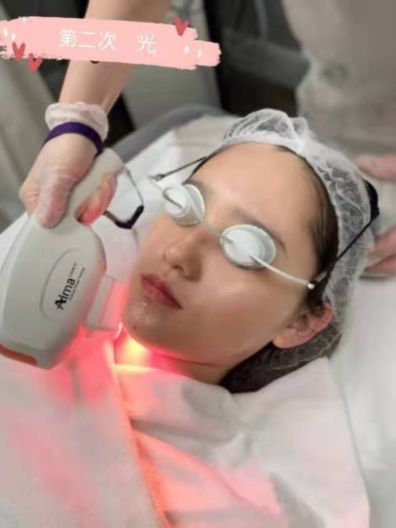 医美初体验——超光子嫩肤