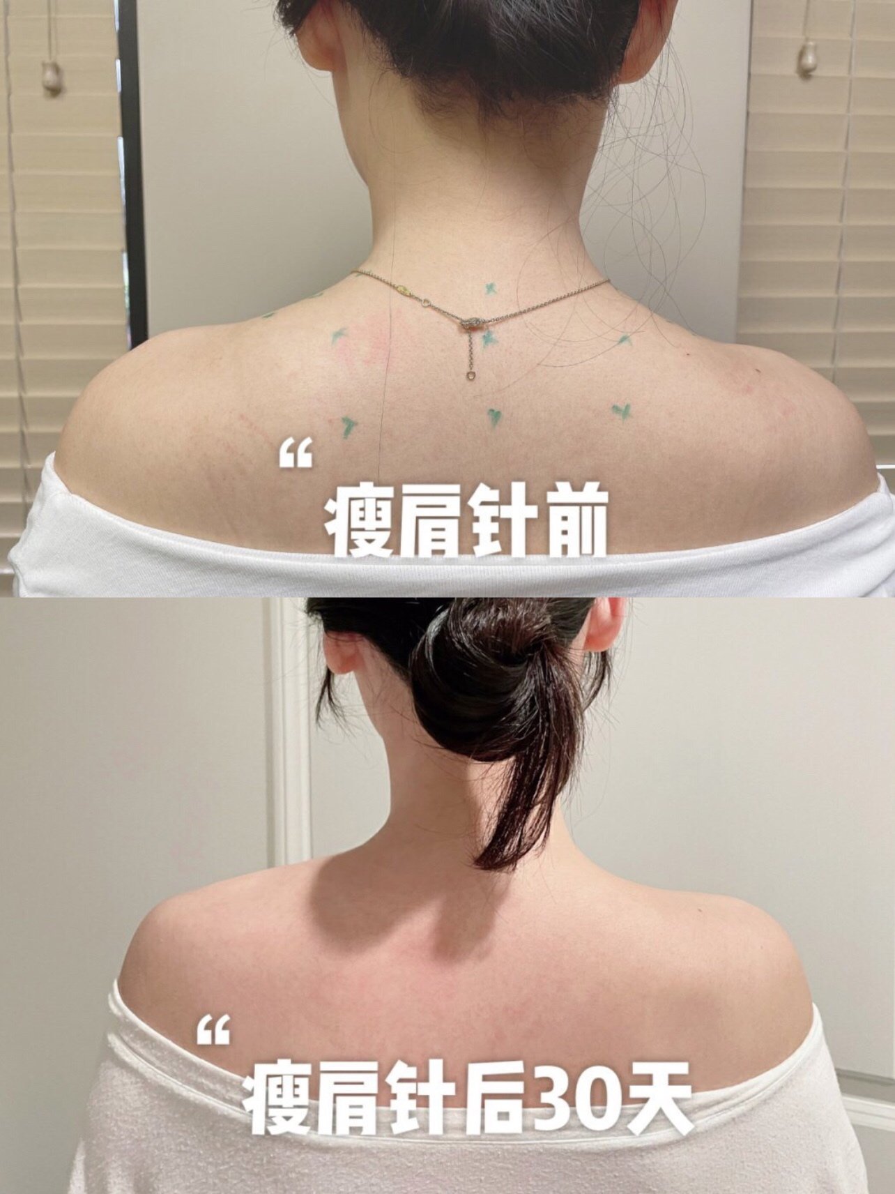 差不多一个月前打的瘦肩针记录76下打针的过程