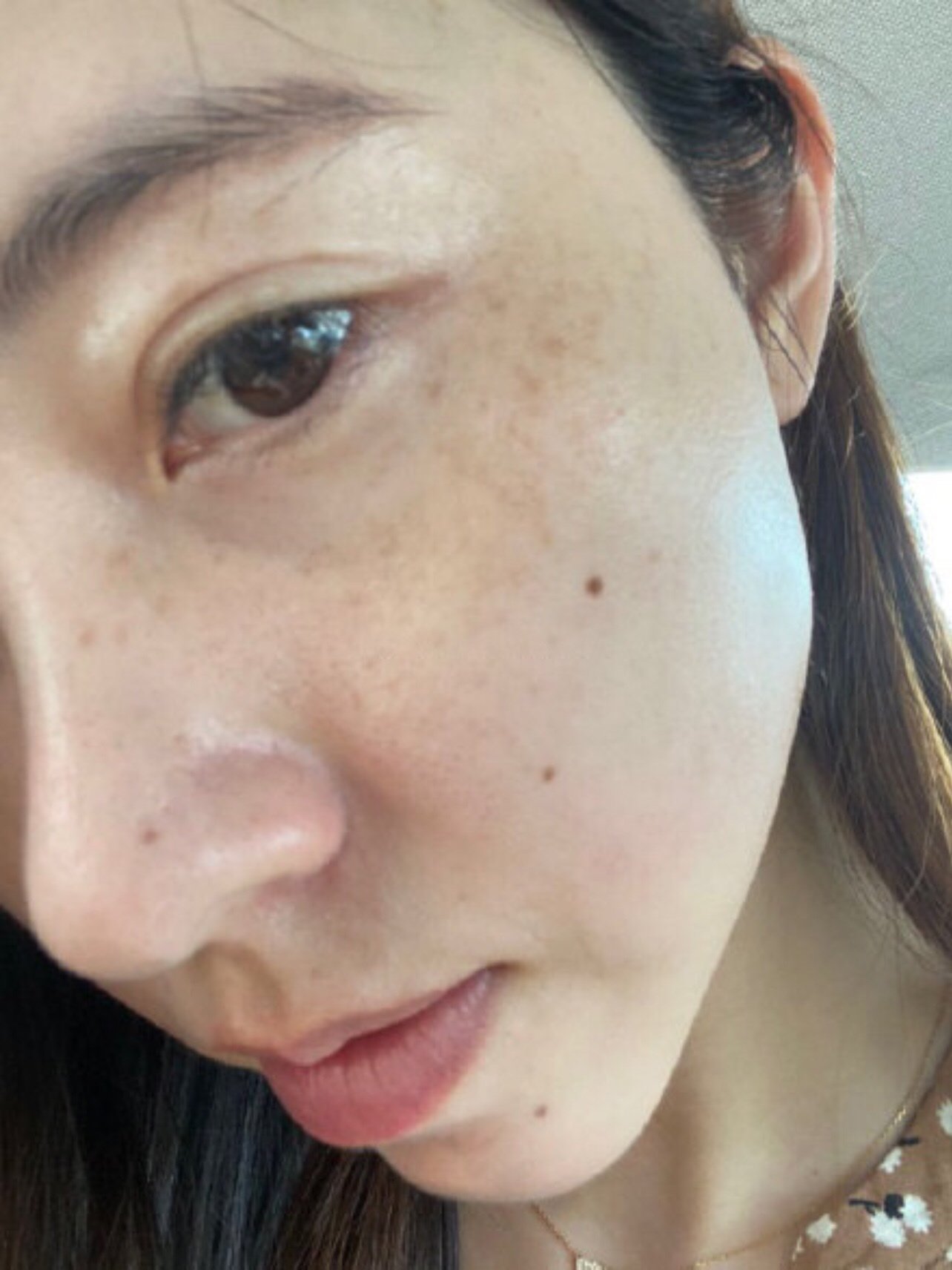 全脸祛斑祛黄嫩肤,皮秒比较稳定,主要针对黑色素的问_圈子-新氧美容