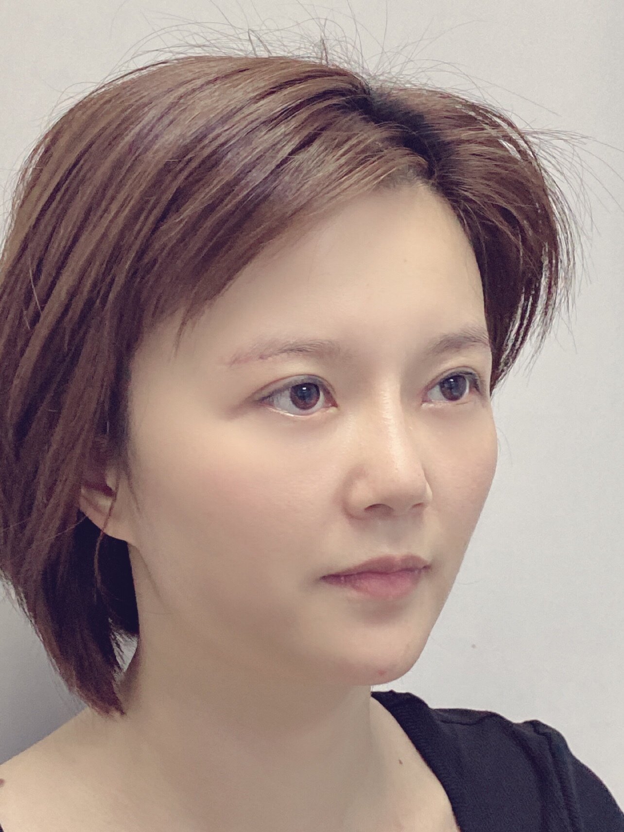 在杨院家做的眼部多项 提眉,现在已经术后两个月了,恢_圈子-新氧美容