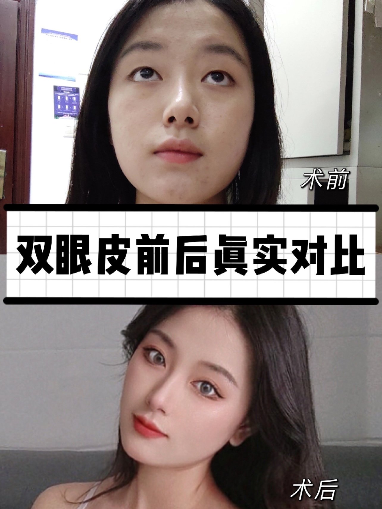 平扇形双眼皮护理攻略大全