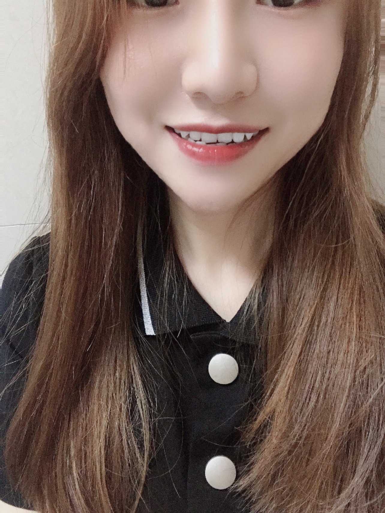 术后第十四天超喜欢自己的小白牙呀!