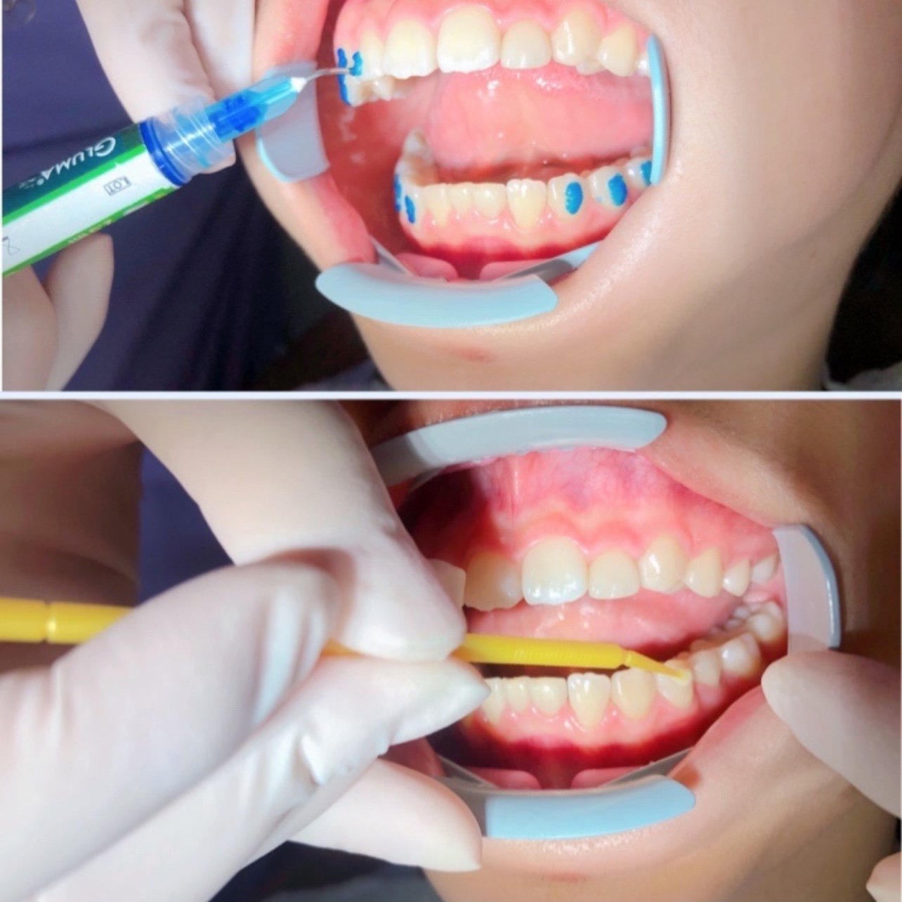 新的牙套回来啦精调粘附件ing73