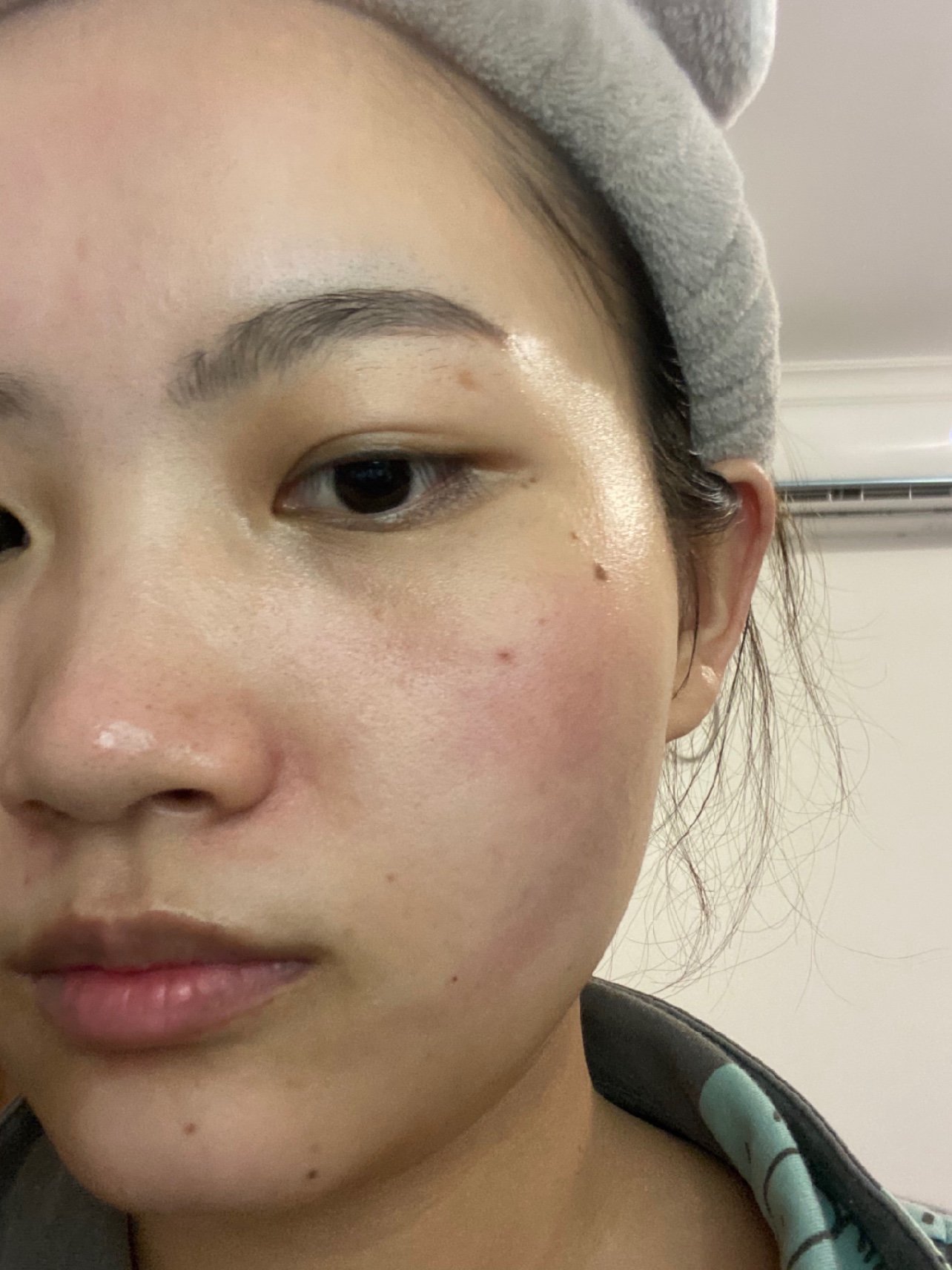 体验前变美诉求:皮肤干燥缺水,换季时鼻翼两侧会干燥脱皮,希望能改善