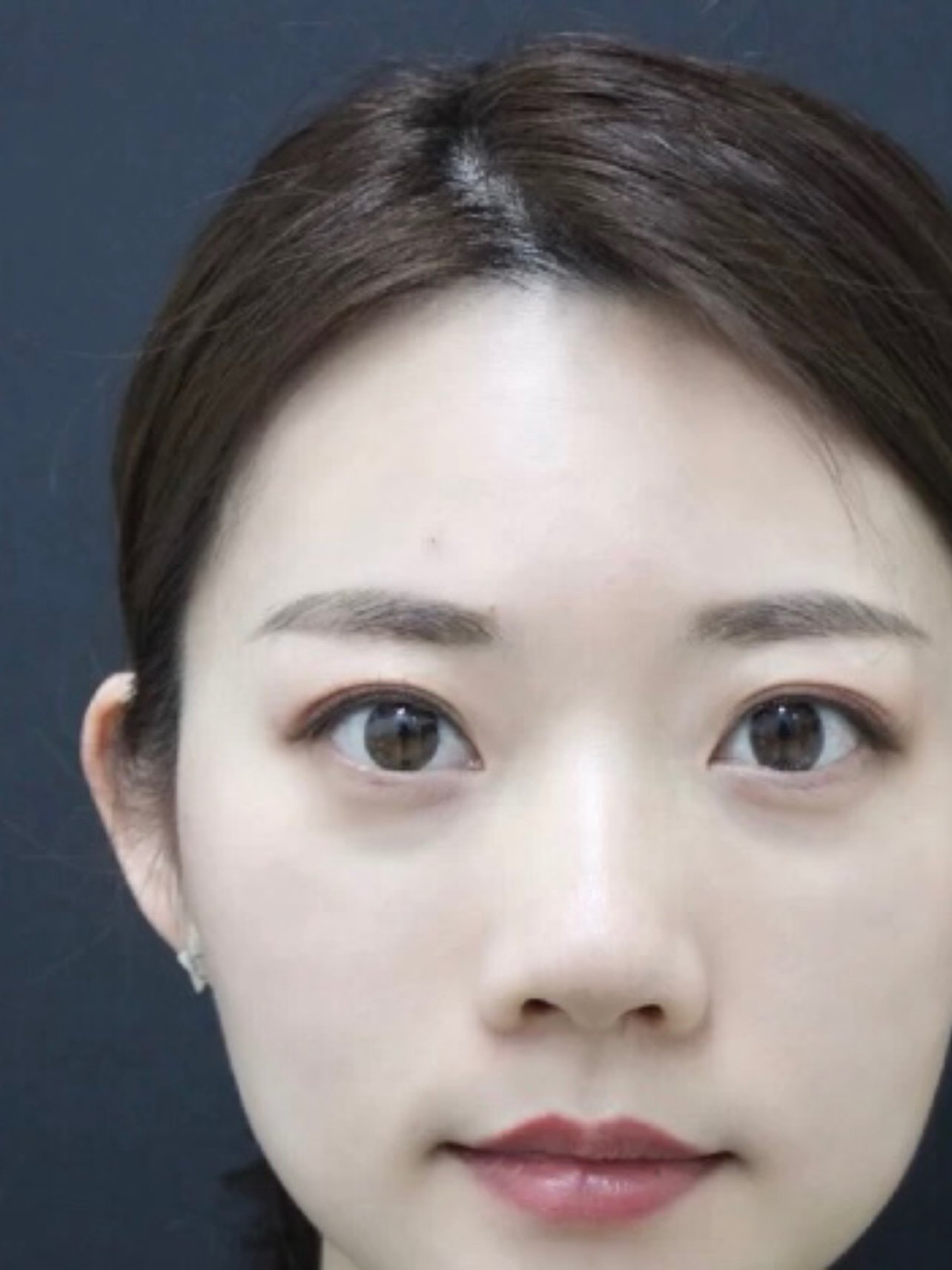 填充了眼沟,之前的自己的眼沟就是凹陷,一熬夜有了黑_圈子-新氧美容