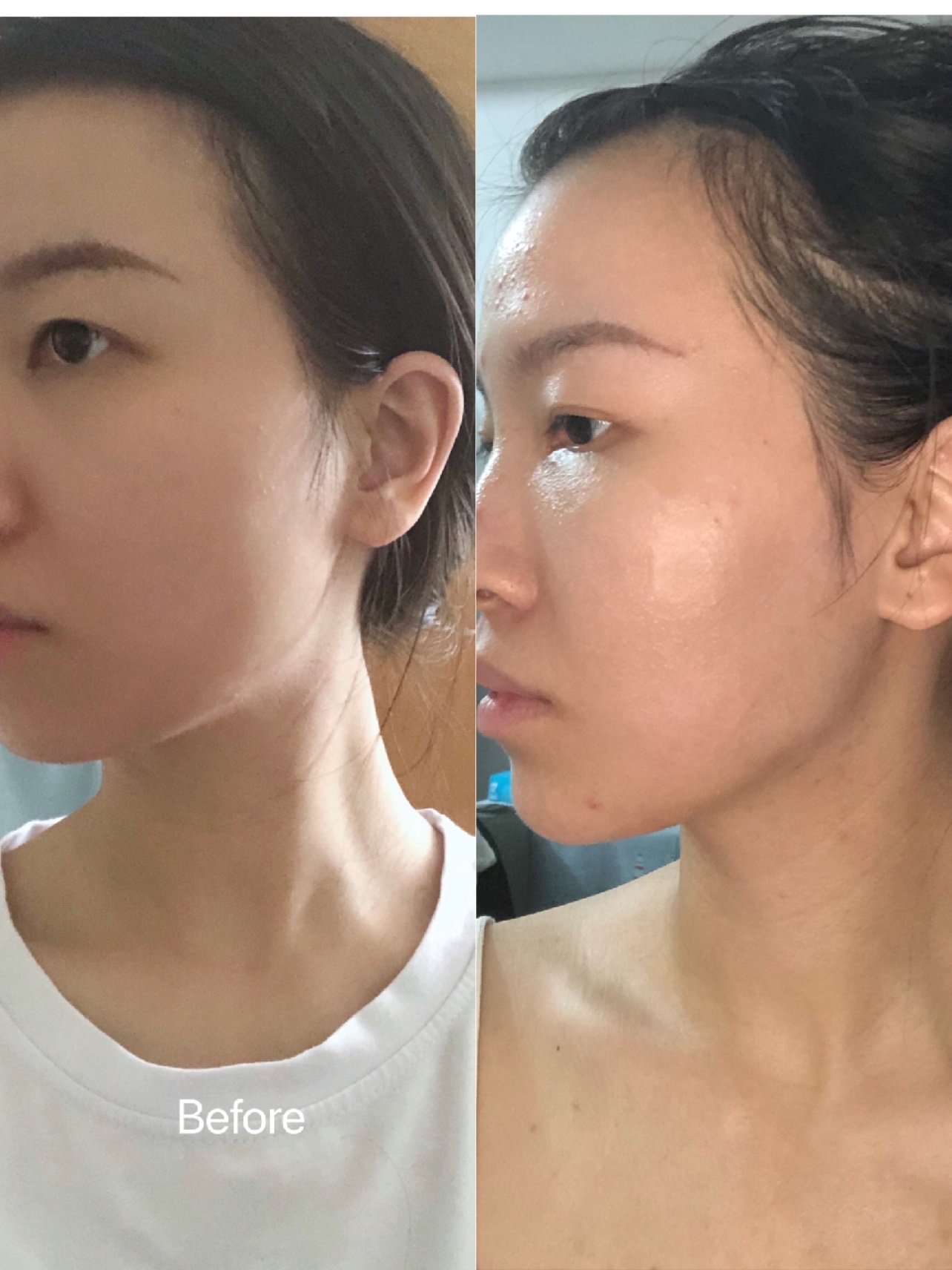 新氧婕尔玻尿酸体验官