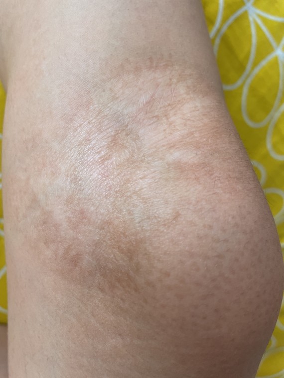 小时候烫伤的疤痕在膝盖上还能去除吗