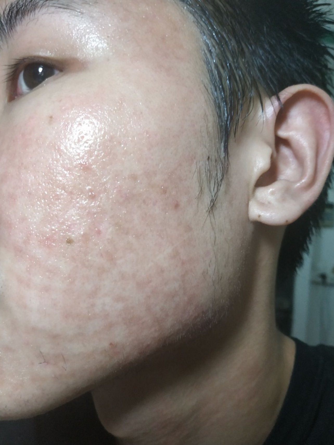 脸上的坑洼特别难看,然后我有个哥们也是在广肤哪里治_圈子-新氧美容