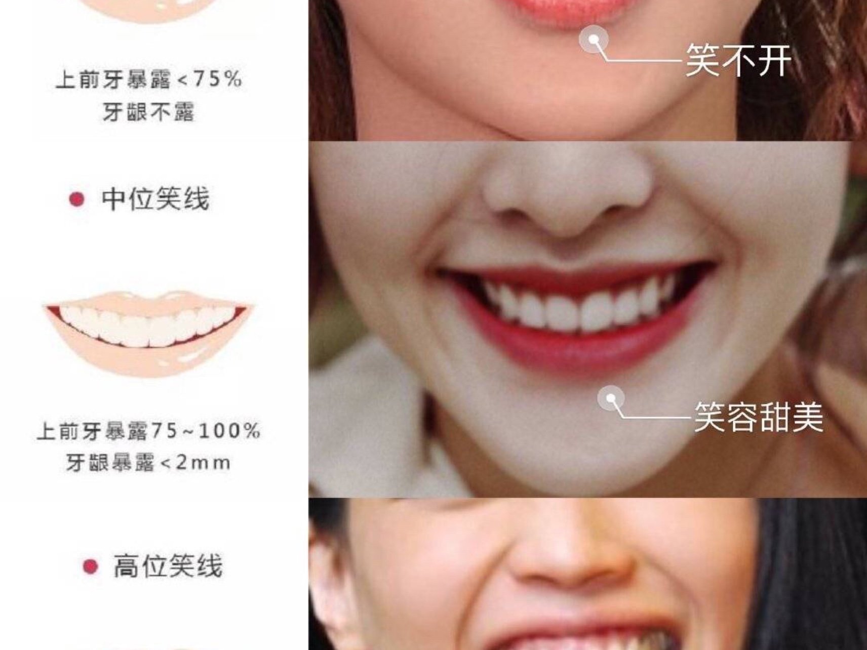 最近做了一些关于微笑线的功课,其实牙齿,牙弓宽窄