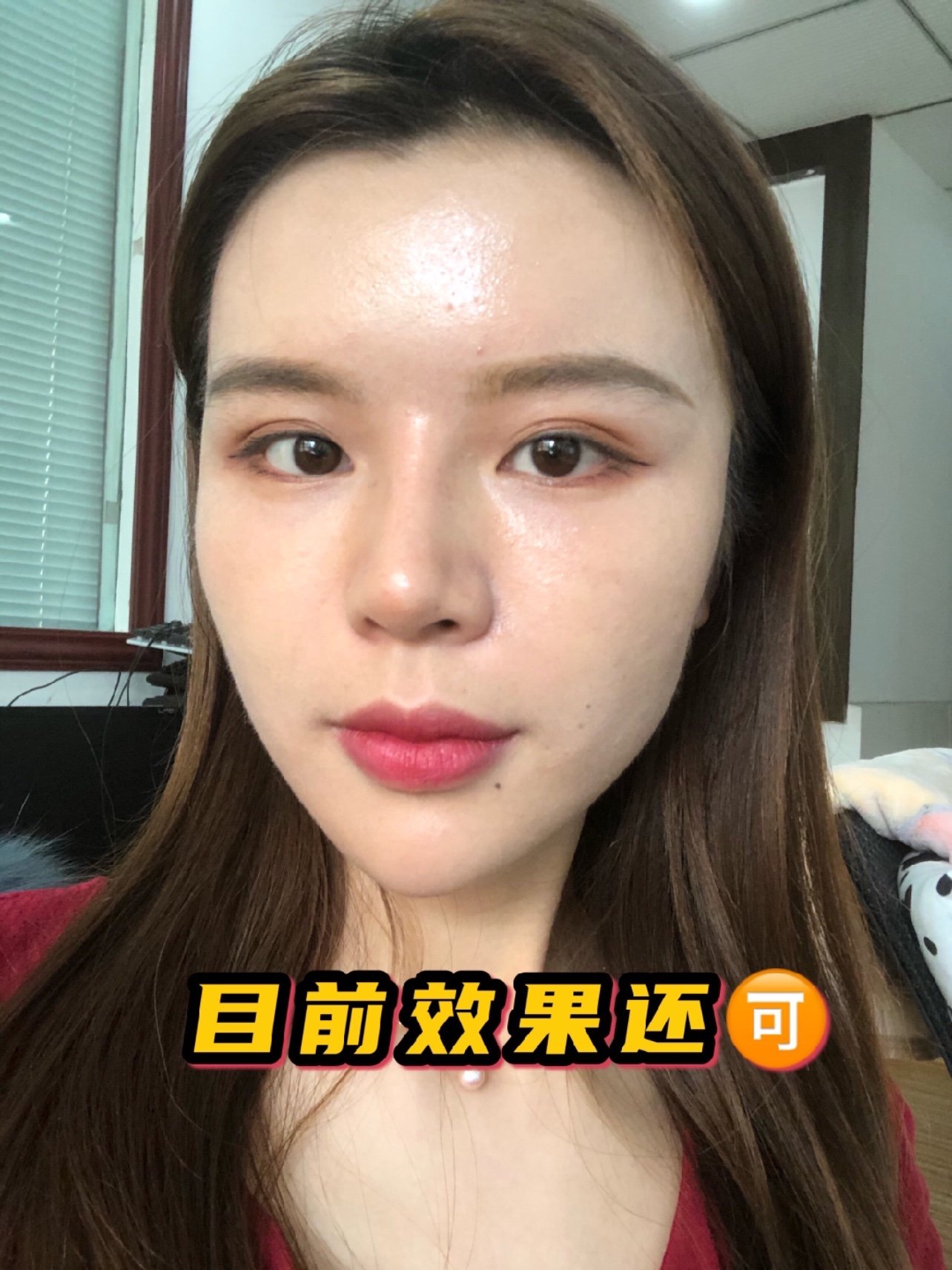 纯干货!玻尿酸注射鼻基底