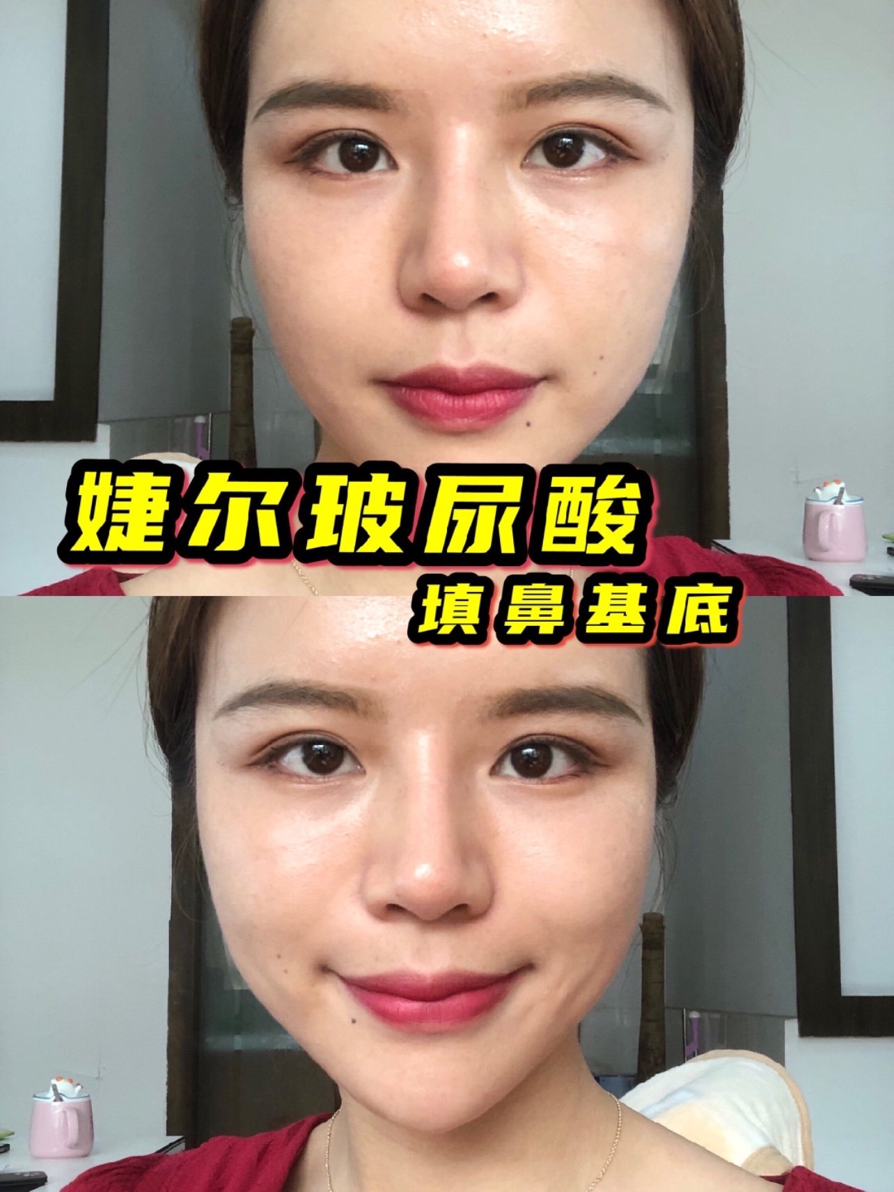 纯干货!玻尿酸注射鼻基底