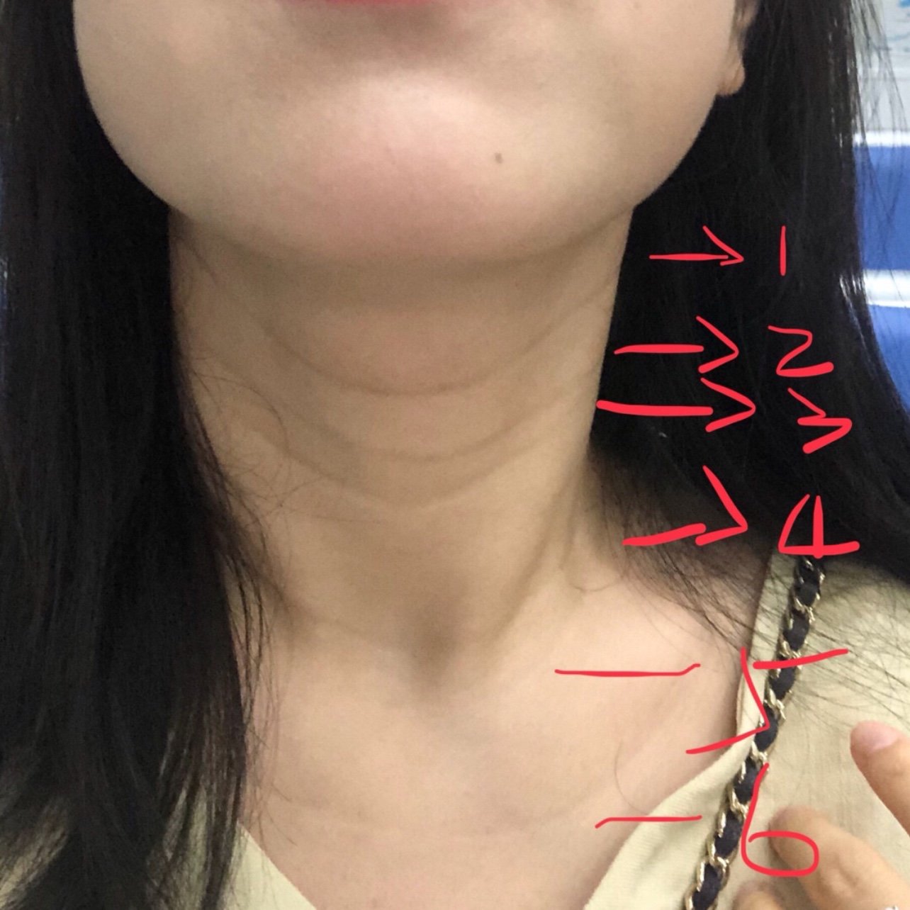 天生的遗传性颈纹,小学的时候就发现有好几条了.