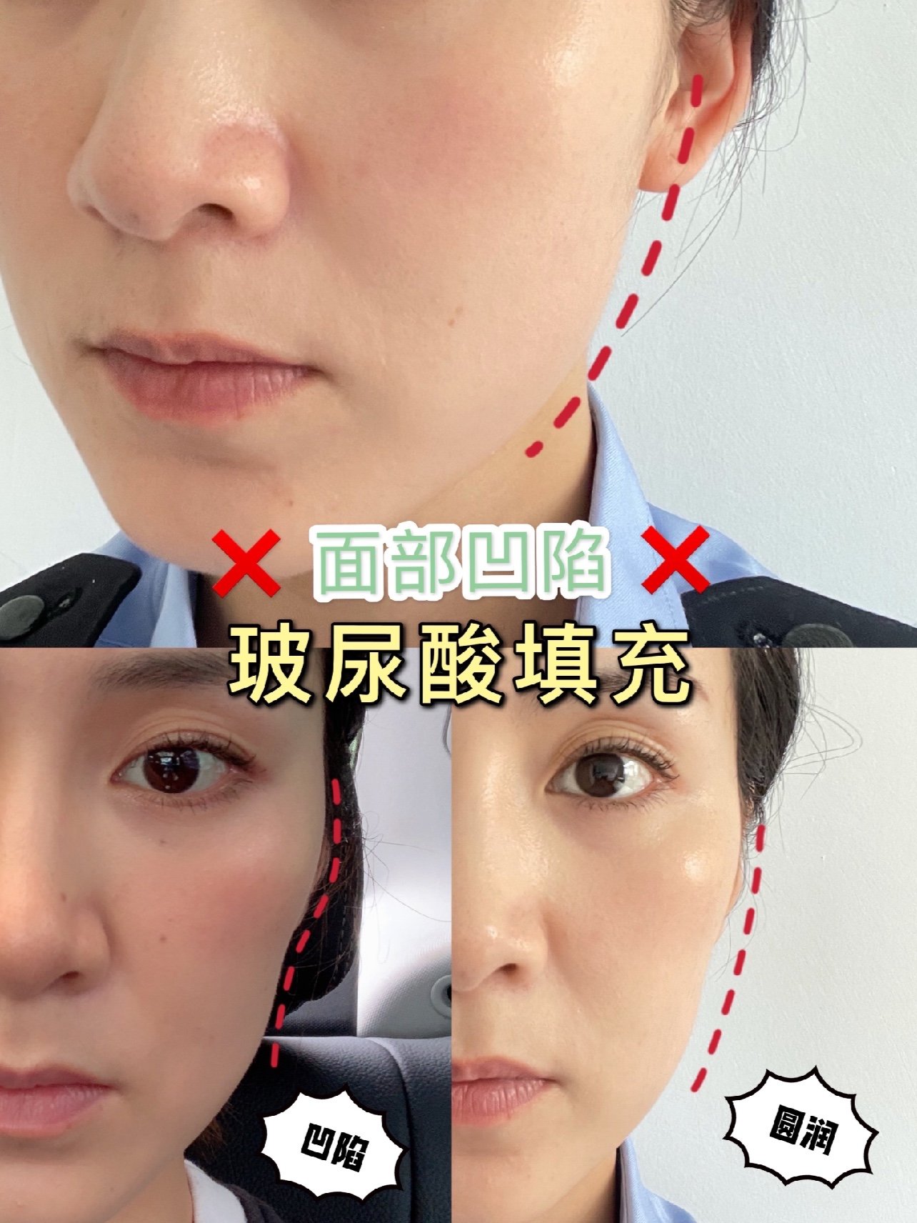 面部凹陷首选玻尿酸填充
