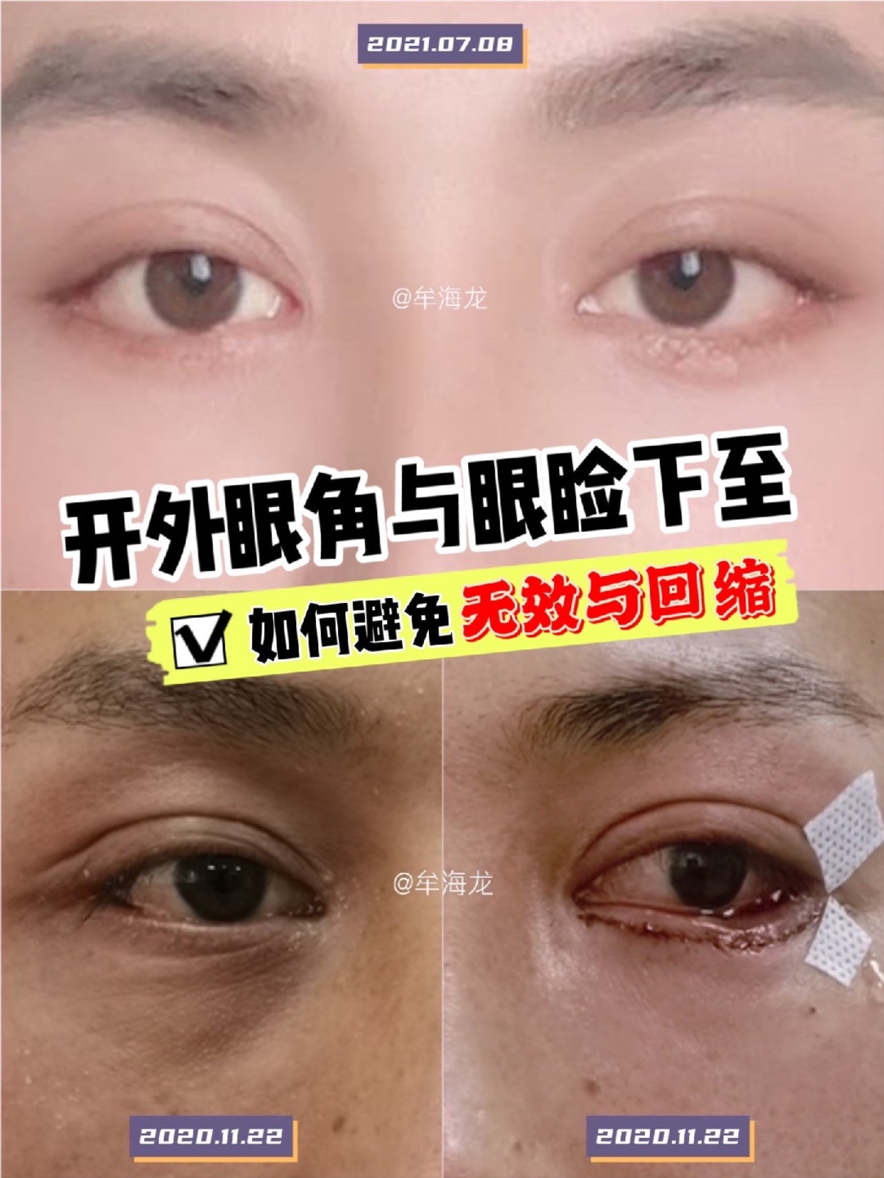 开外眼角下眼睑下至如何避免没效果和回缩