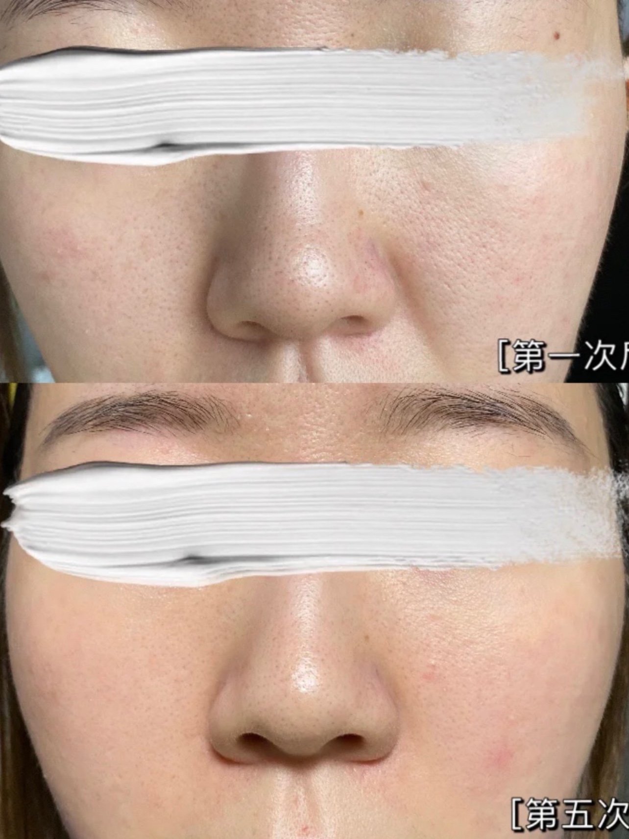 又去做了一次黑金超光子,据说是"光子嫩肤中的爱马仕_圈子-新氧美容