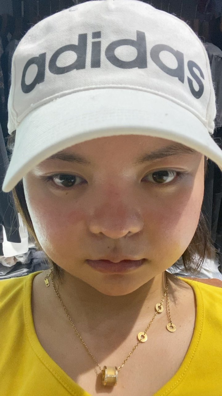 左脸肿的明显一点每天很焦虑吃的也多了复胖了一些00