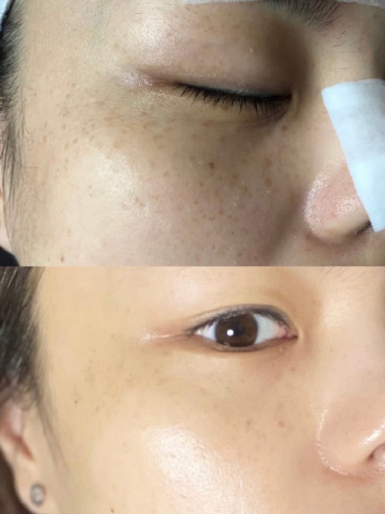 做完超皮秒祛斑激光后该如何预防反弹反黑情况呢