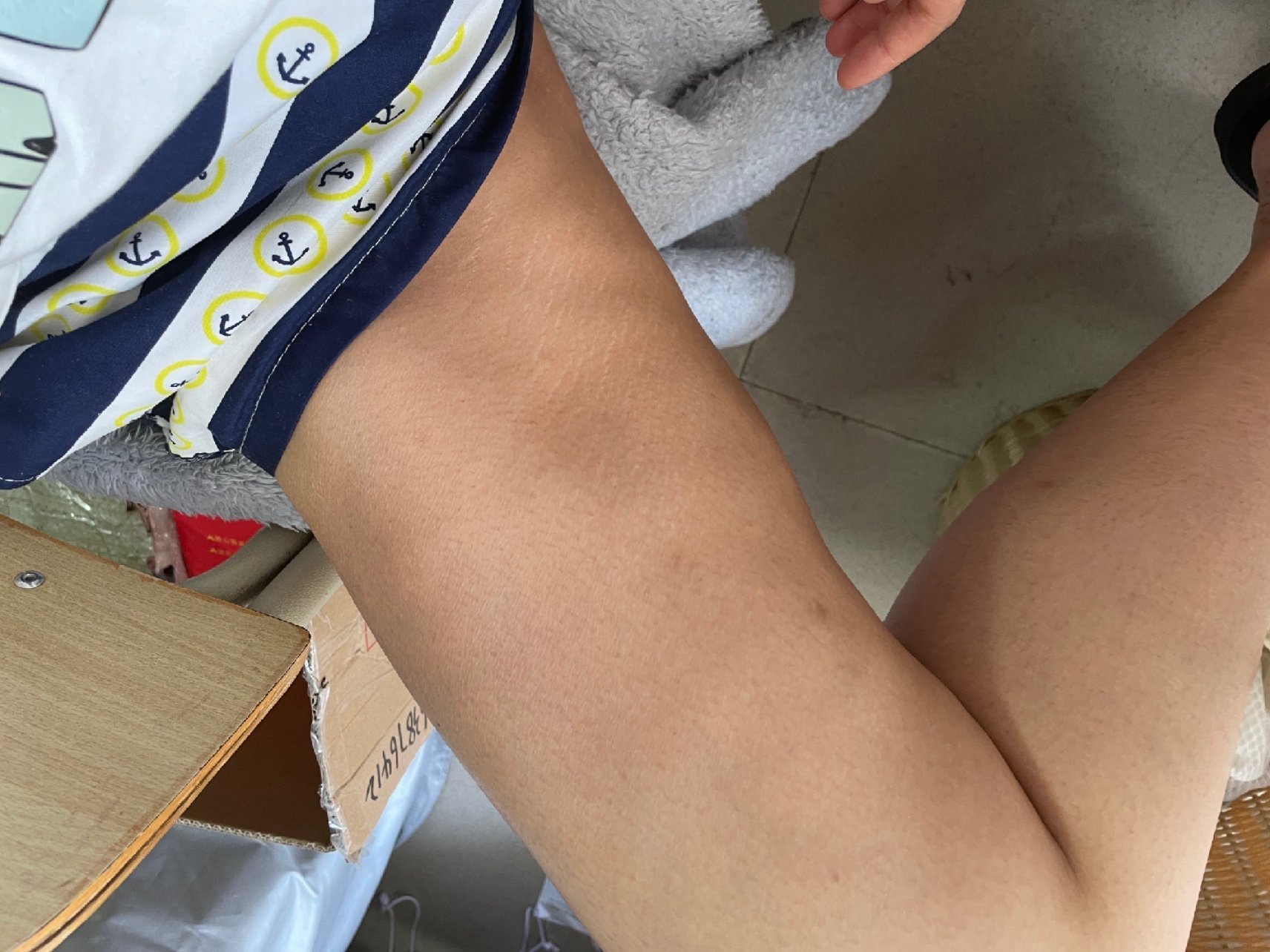 吸脂后凹凸不平,这是隔1年后又去他们医院花了麻醉费_圈子-新氧美容