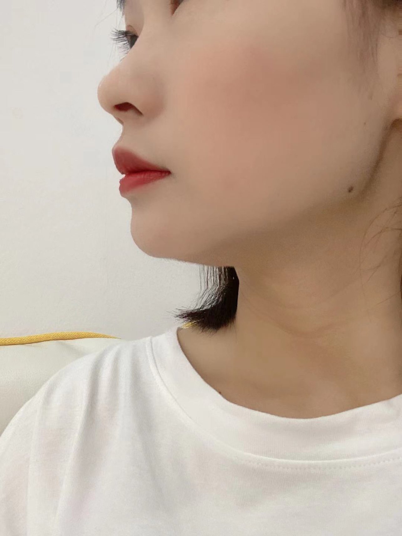 现在术后70天,侧面下巴连接脖子的部分都已经完全定_圈子-新氧美容