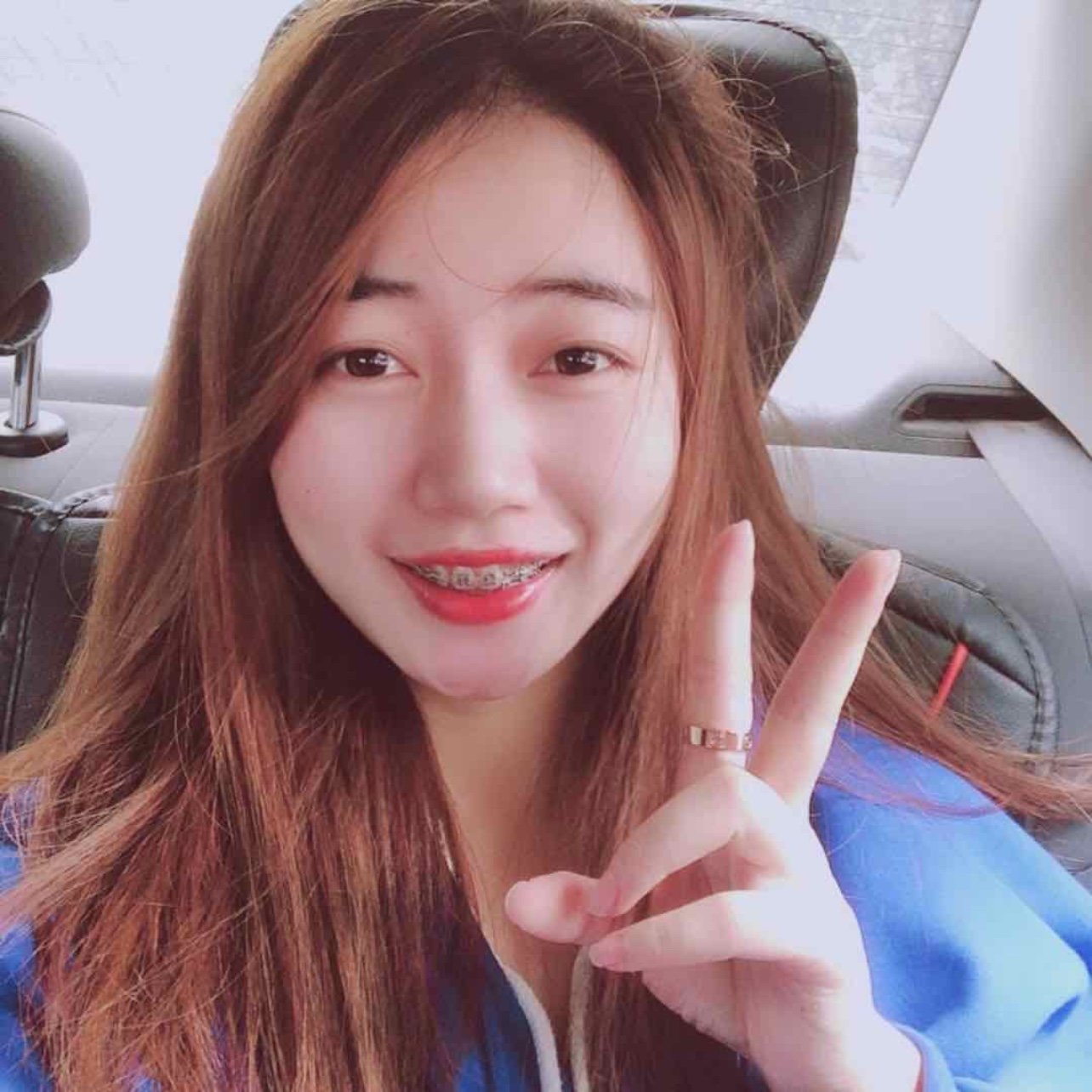 整牙变女神戴了两年的牙套,牙套特别考验医生技术,_圈子-新氧美容